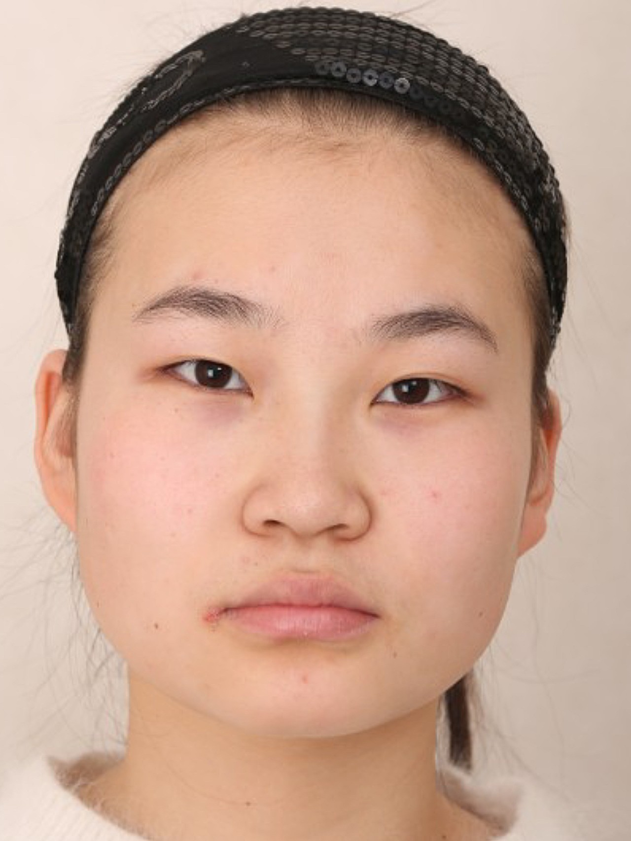 前诊断术前单眼皮,眼部脂肪多,内眦赘皮方案设计通_圈子-新氧美容整形