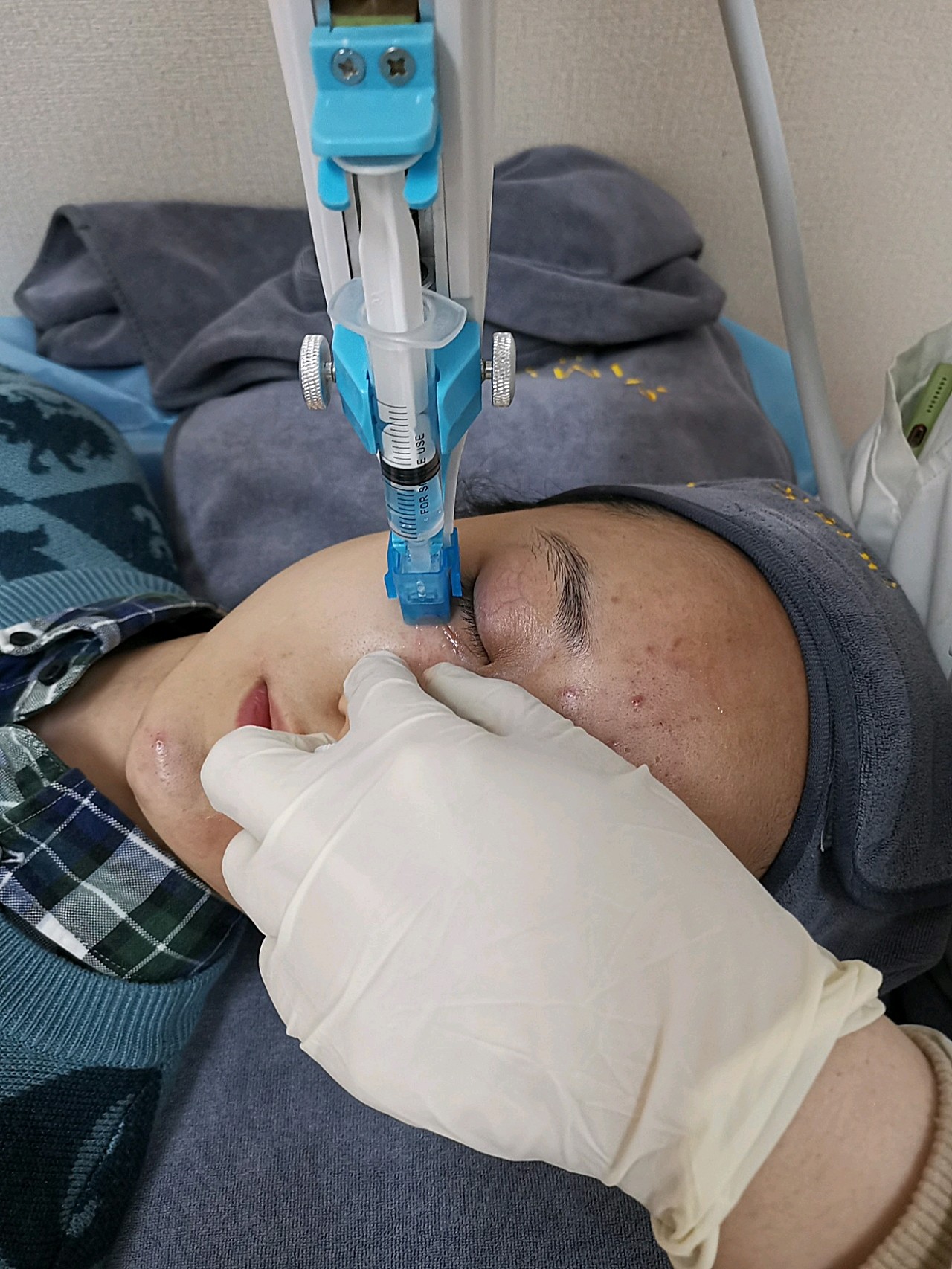 做完胶原微针之后