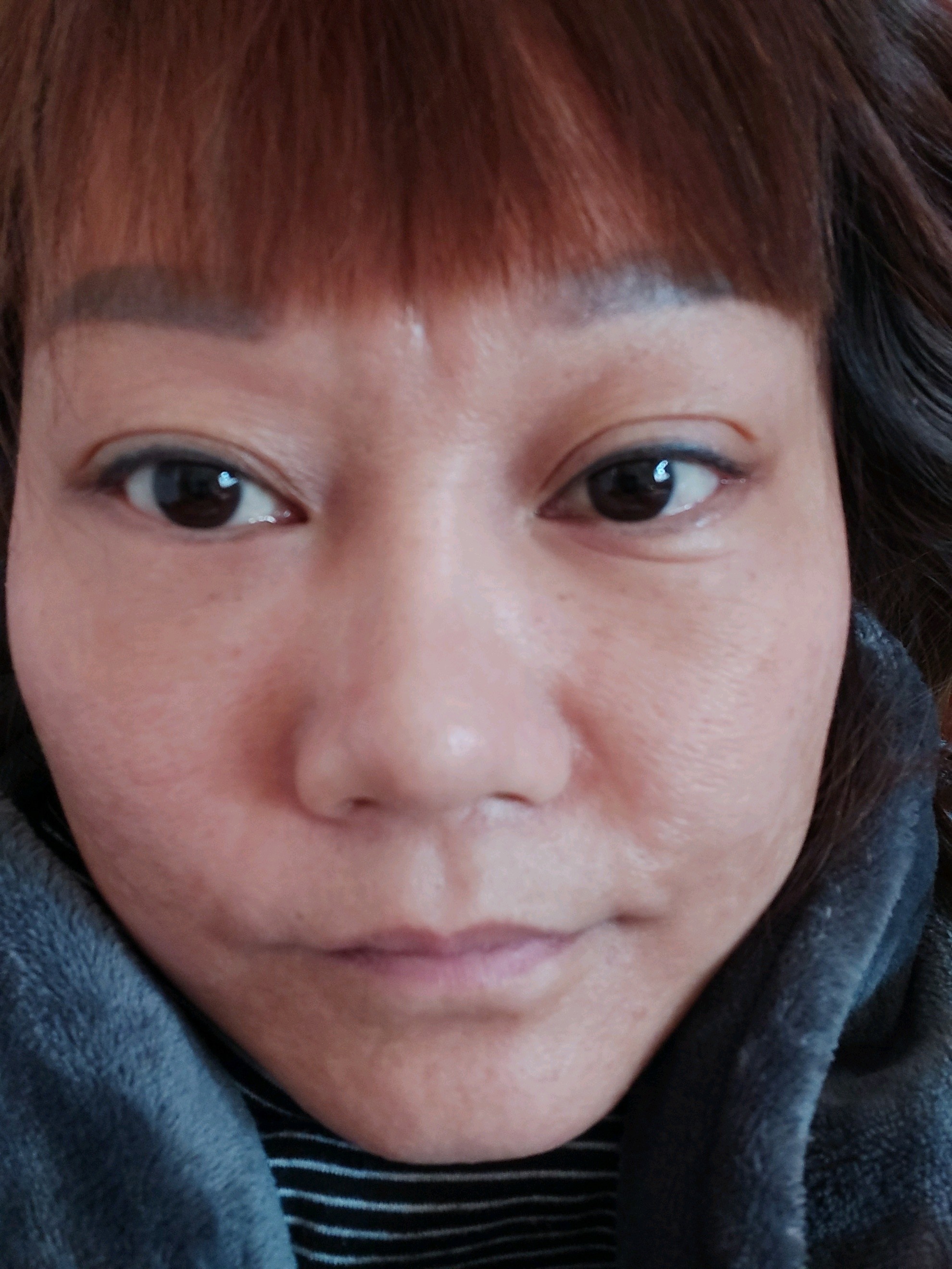 还是这个样子,该改善的地方没有改善 ,哪里像外切眼袋手术后的样子,下