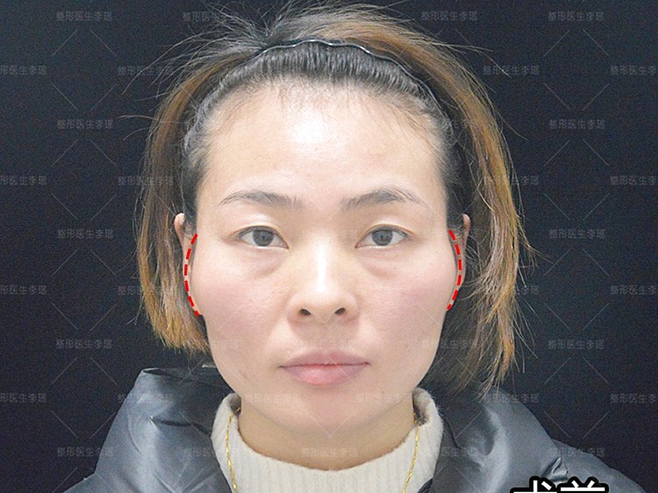 这个顾客颧骨宽高,颞部凹陷,面颊凹陷通过颧弓吸脂和颞部面颊自体脂肪