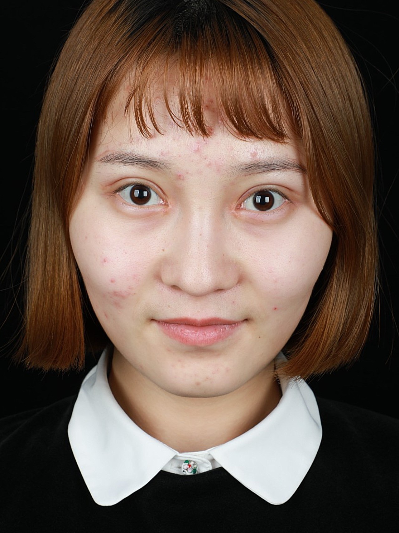 术前有点内双,双眼皮不明显,且眼睛稍微显小无神