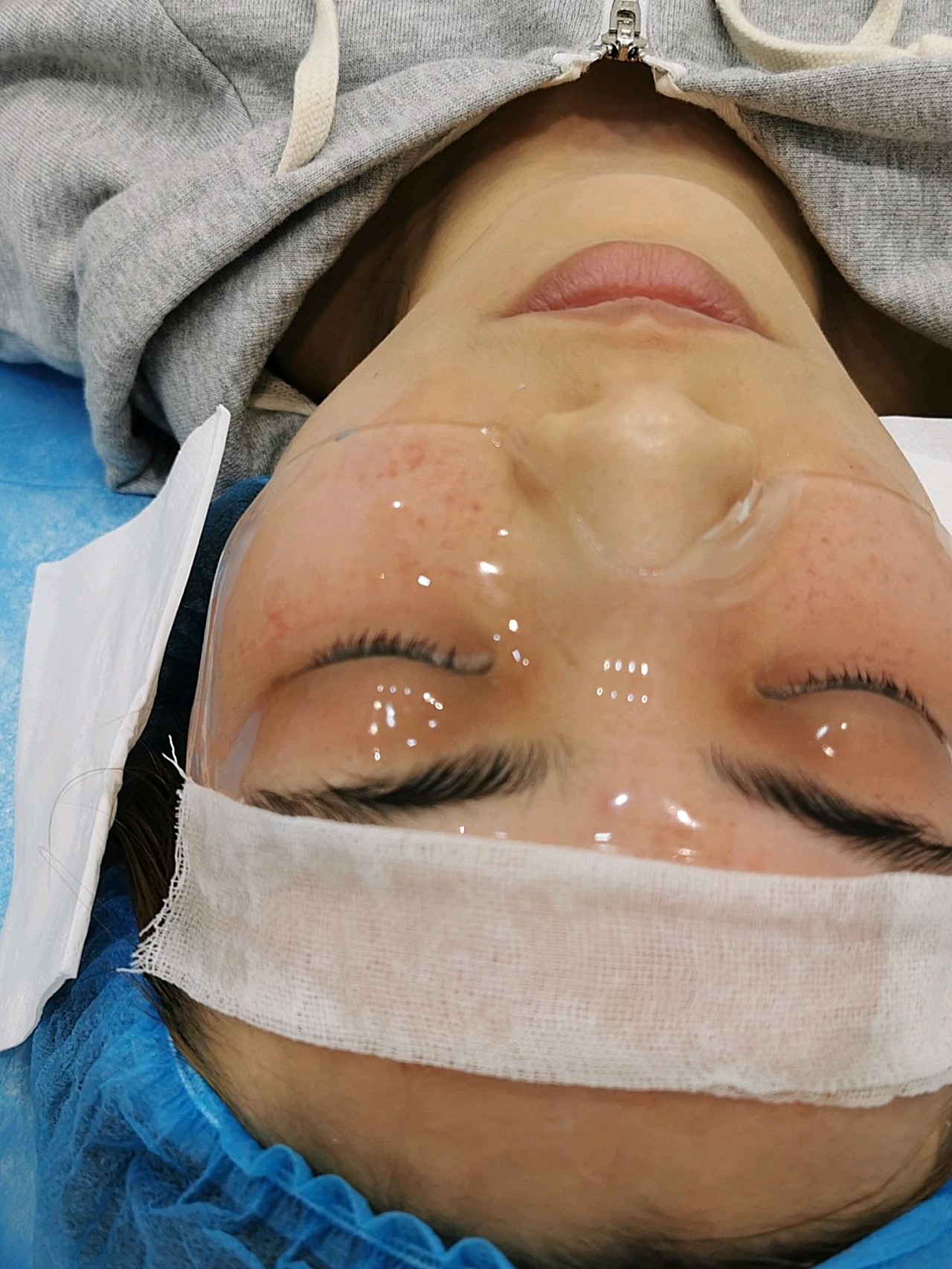 眼部黄金微针做完的第十三日它来了!