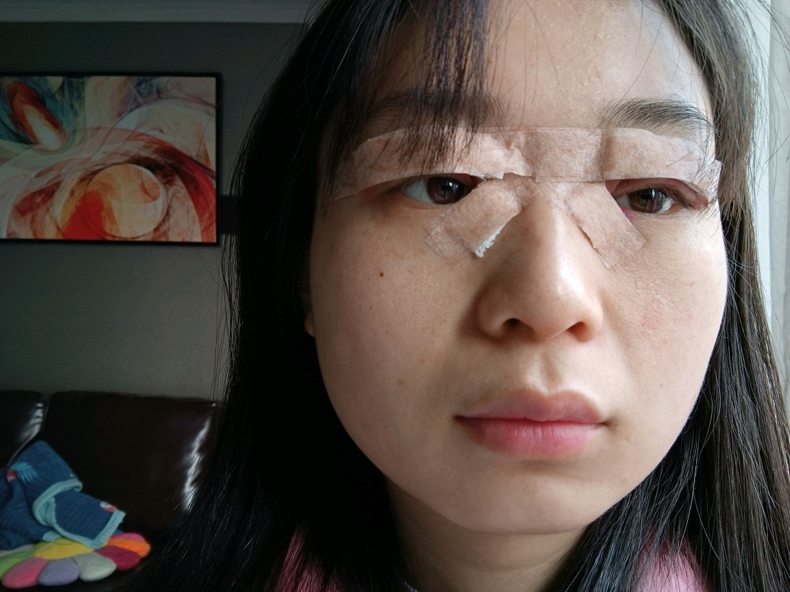 第一天:开眼角77全切,去皮去脂.