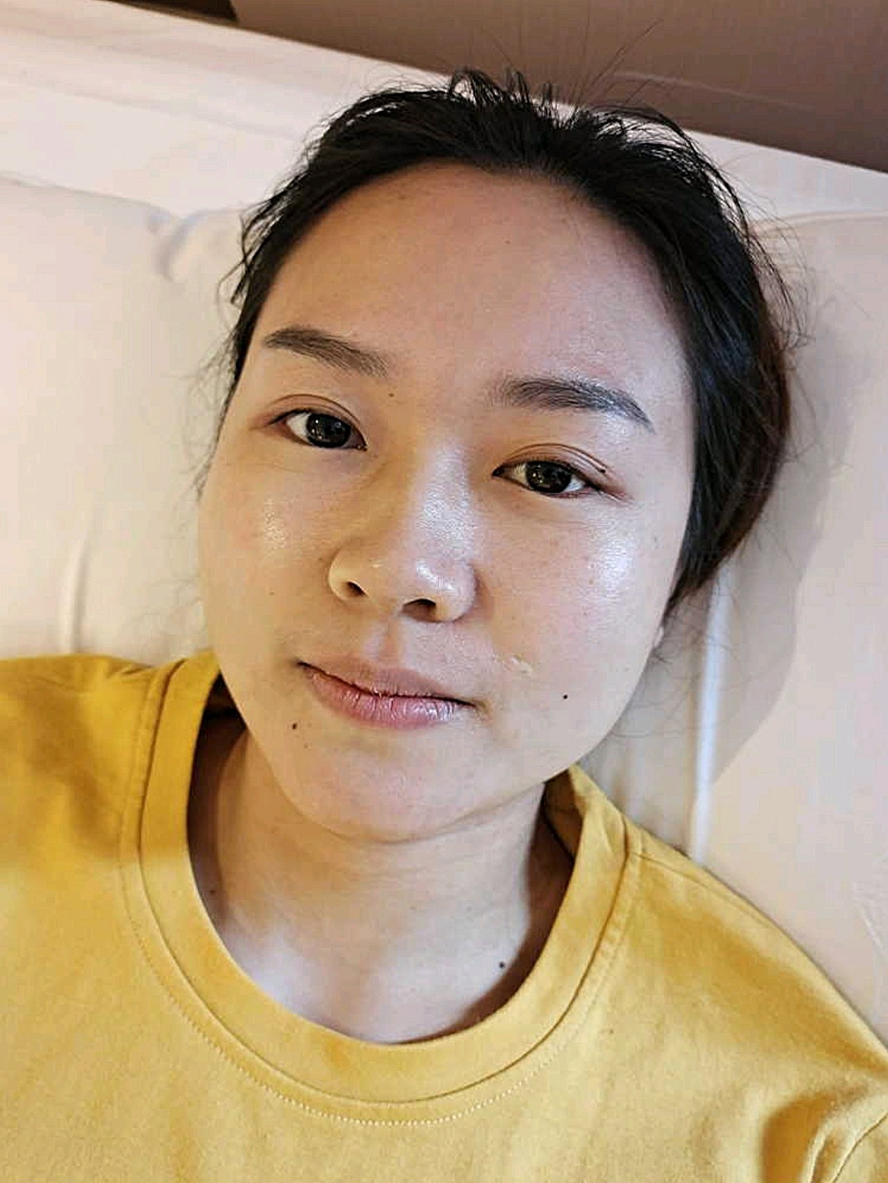 离子束激光祛疤确实挺有效果的,目前是治疗68天的效_圈子-新氧美容