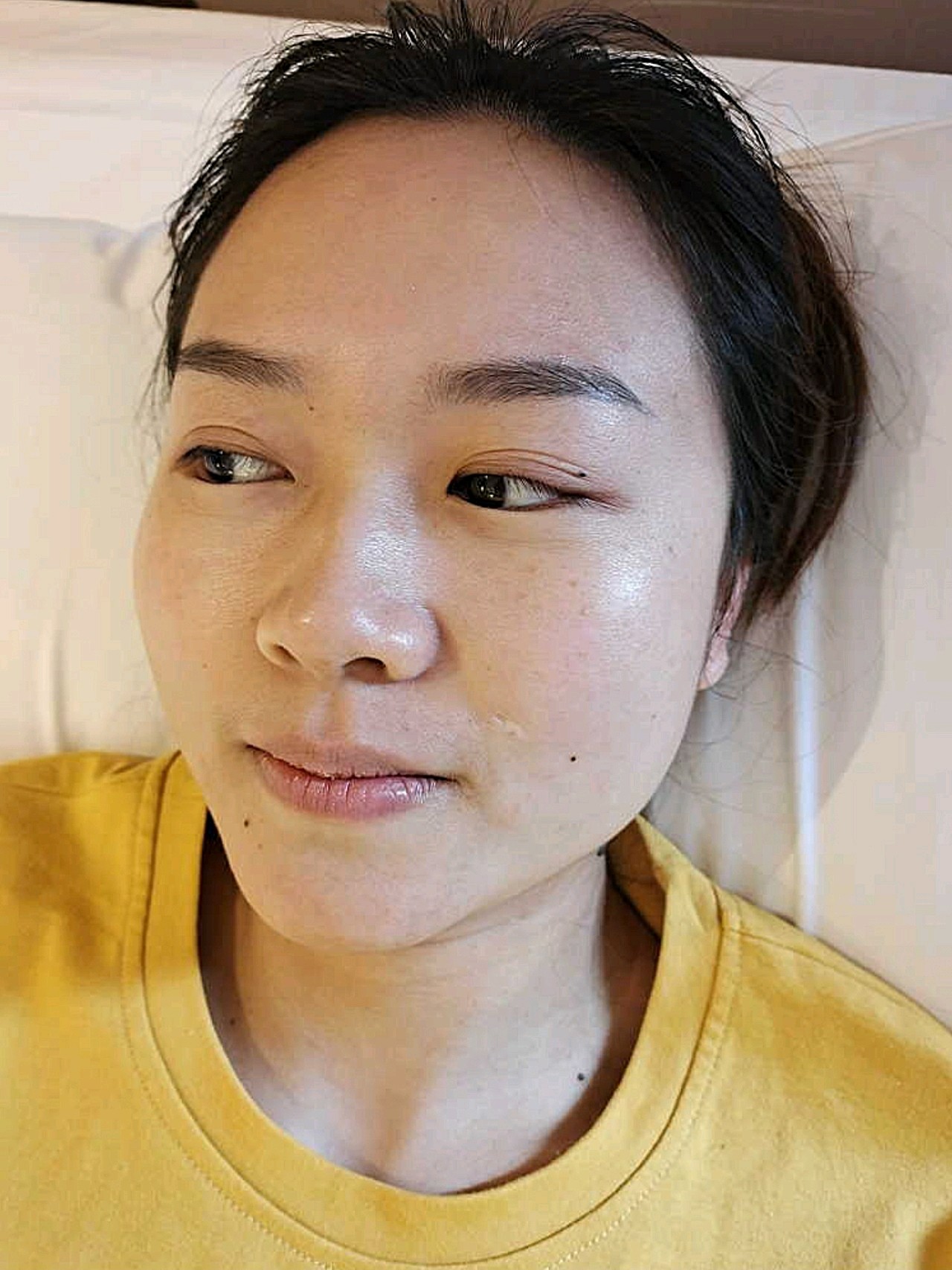 离子束激光祛疤确实挺有效果的,目前是治疗68天的效_圈子-新氧美容