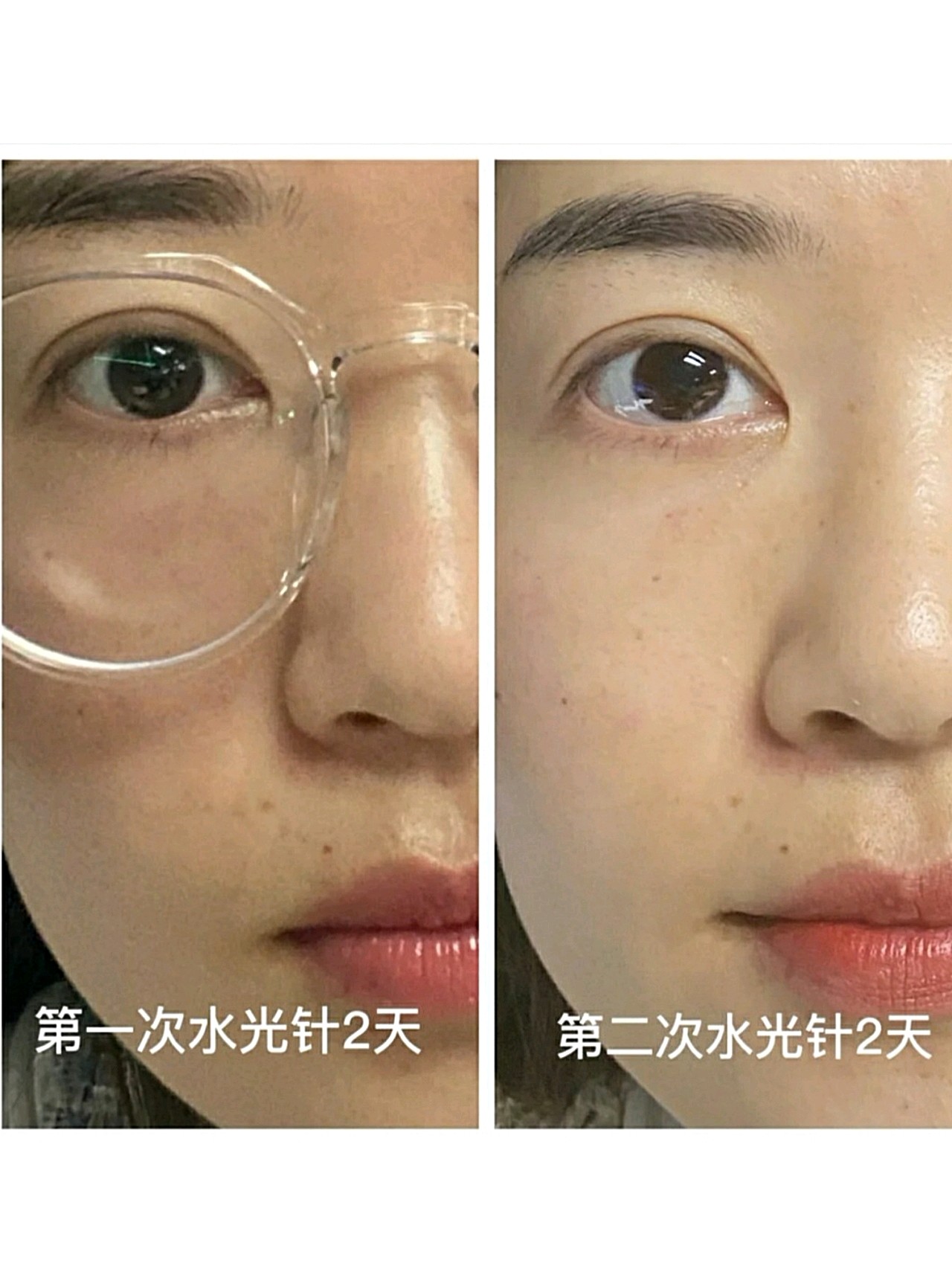 第二次水光选择 菲洛嘉手打眼周 法令纹 两支基础水光润月雅机打全脸