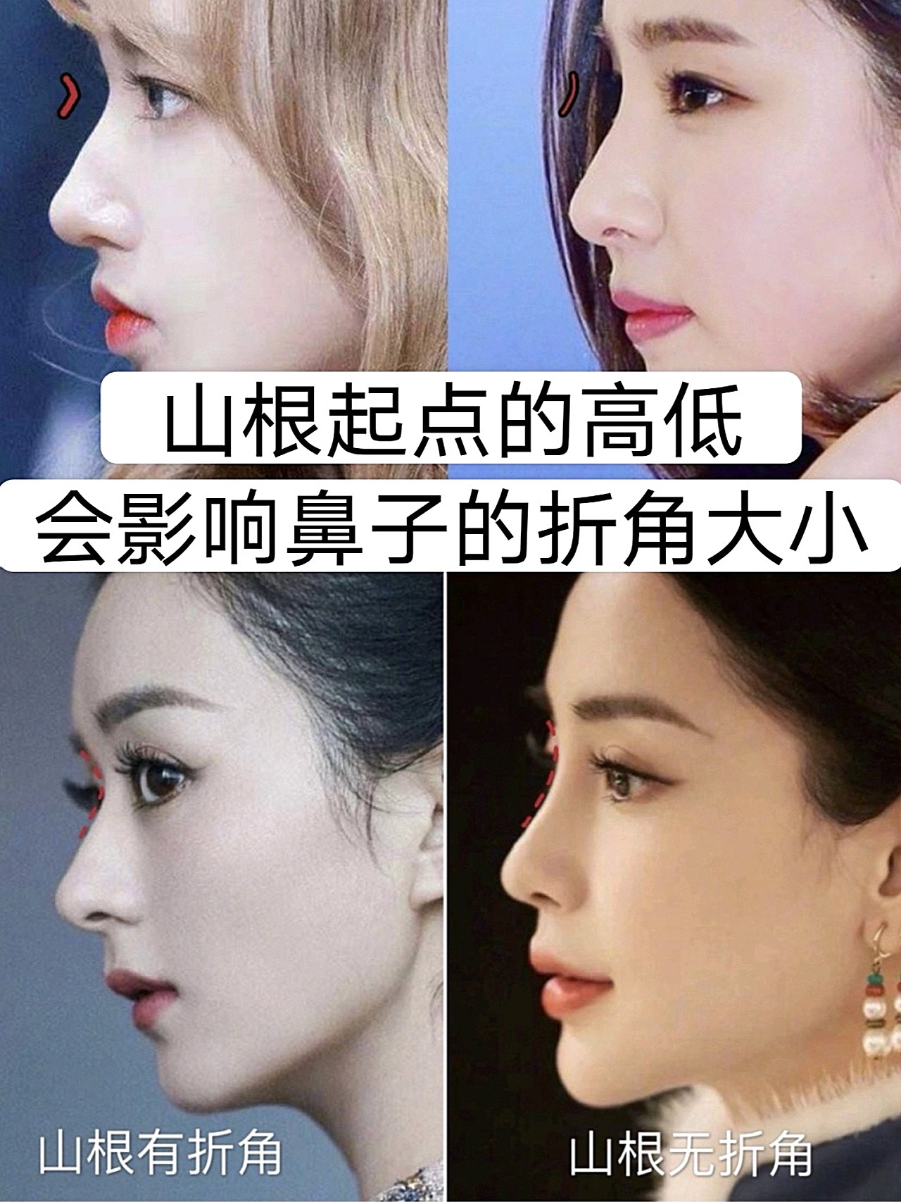 9199鼻审美必懂|你适合什么样的山根9571-鼻山根是否_圈子