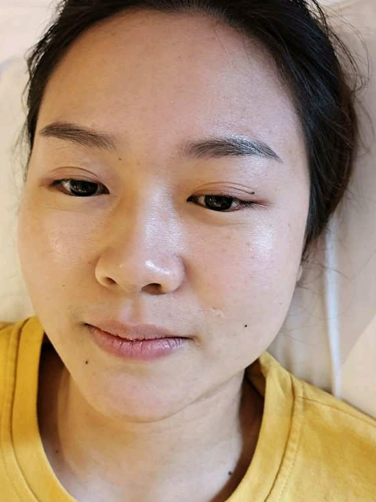 离子束激光祛疤确实挺有效果的,目前是治疗68天的效_圈子-新氧美容