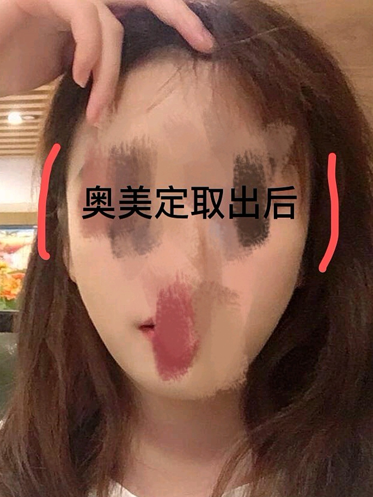 注射奥美定部位出现凸起怎么取出