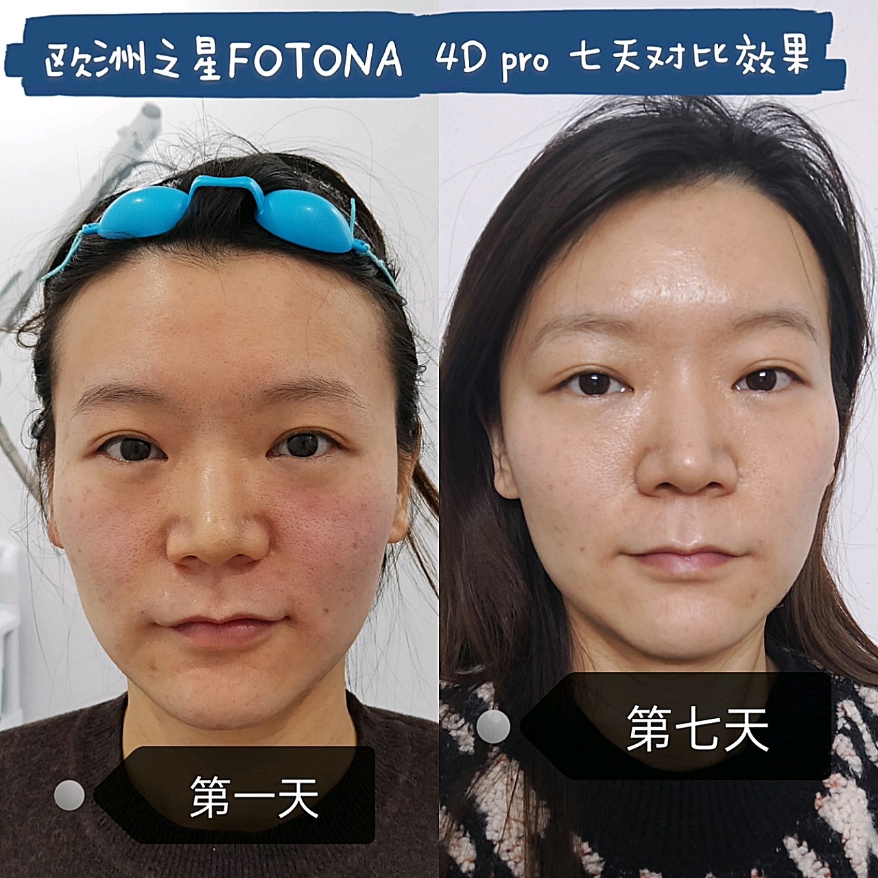 连巨星卡戴珊都痴迷的项目—欧洲之星fotona _圈子-新氧美容整形