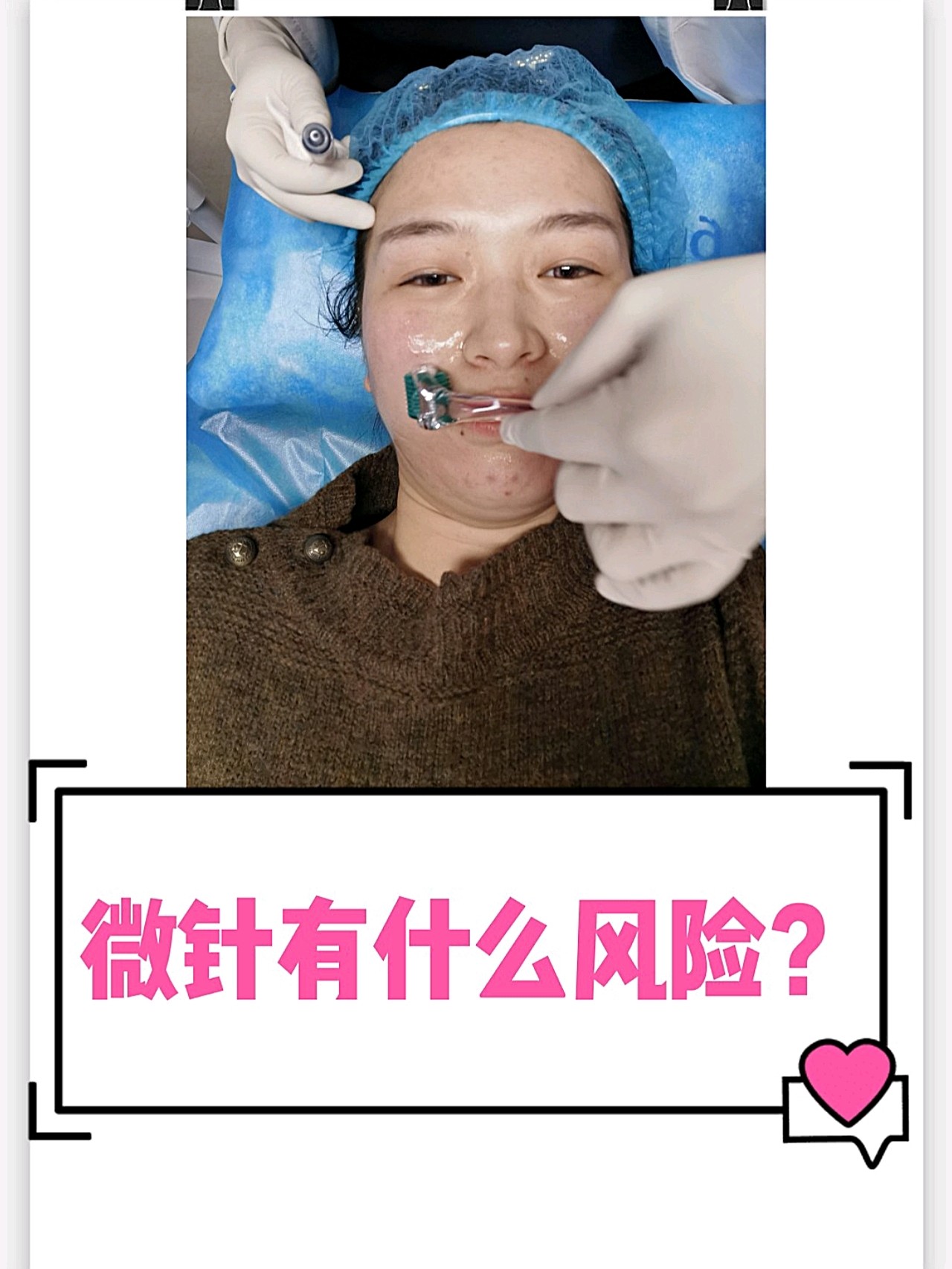 微针存在什么样的风险?