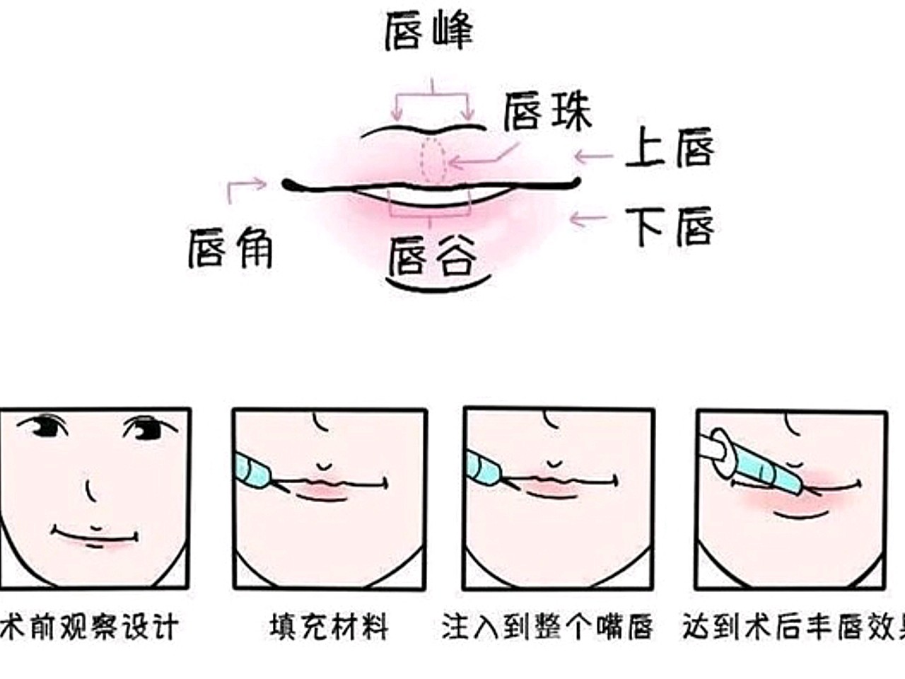 提到玻尿酸,你一定不陌生,"女明星必做项目","皮肤天然,安全"等噱头