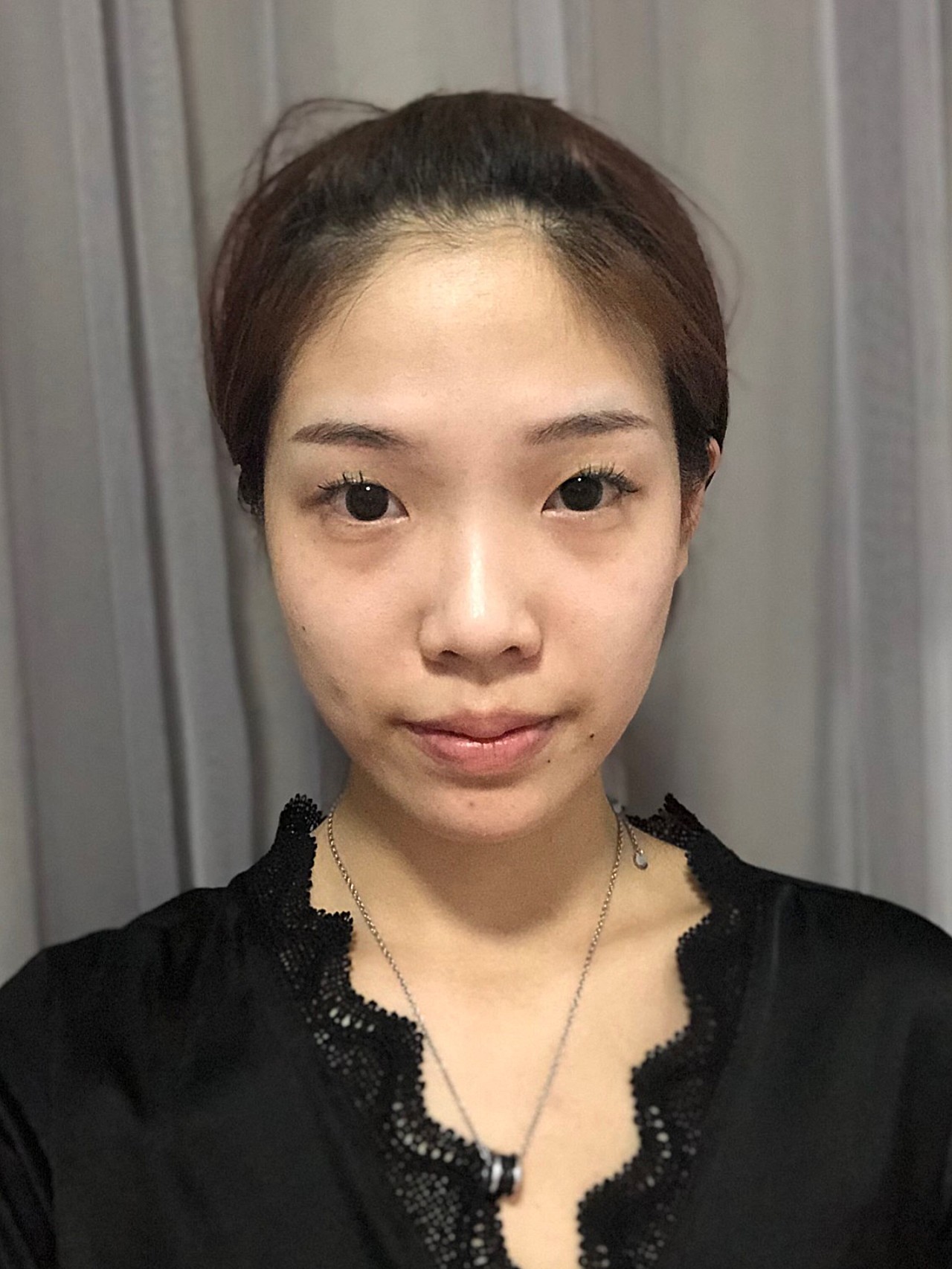 单眼皮 内眦赘皮 上眼睑轻微松弛
