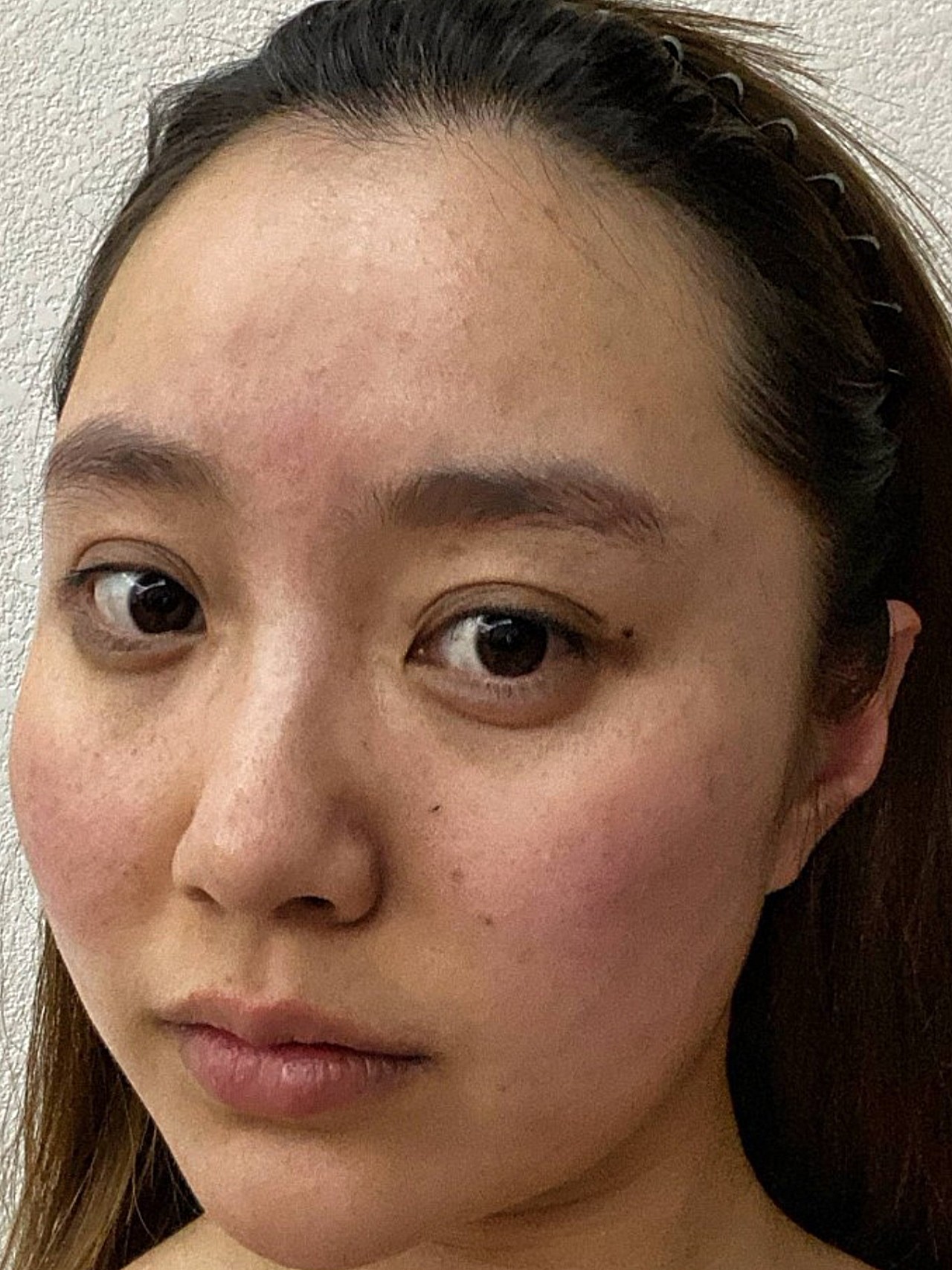 术前诊断这位求美者的脸部皮肤松弛下垂的状态很明显,_圈子-新氧美容