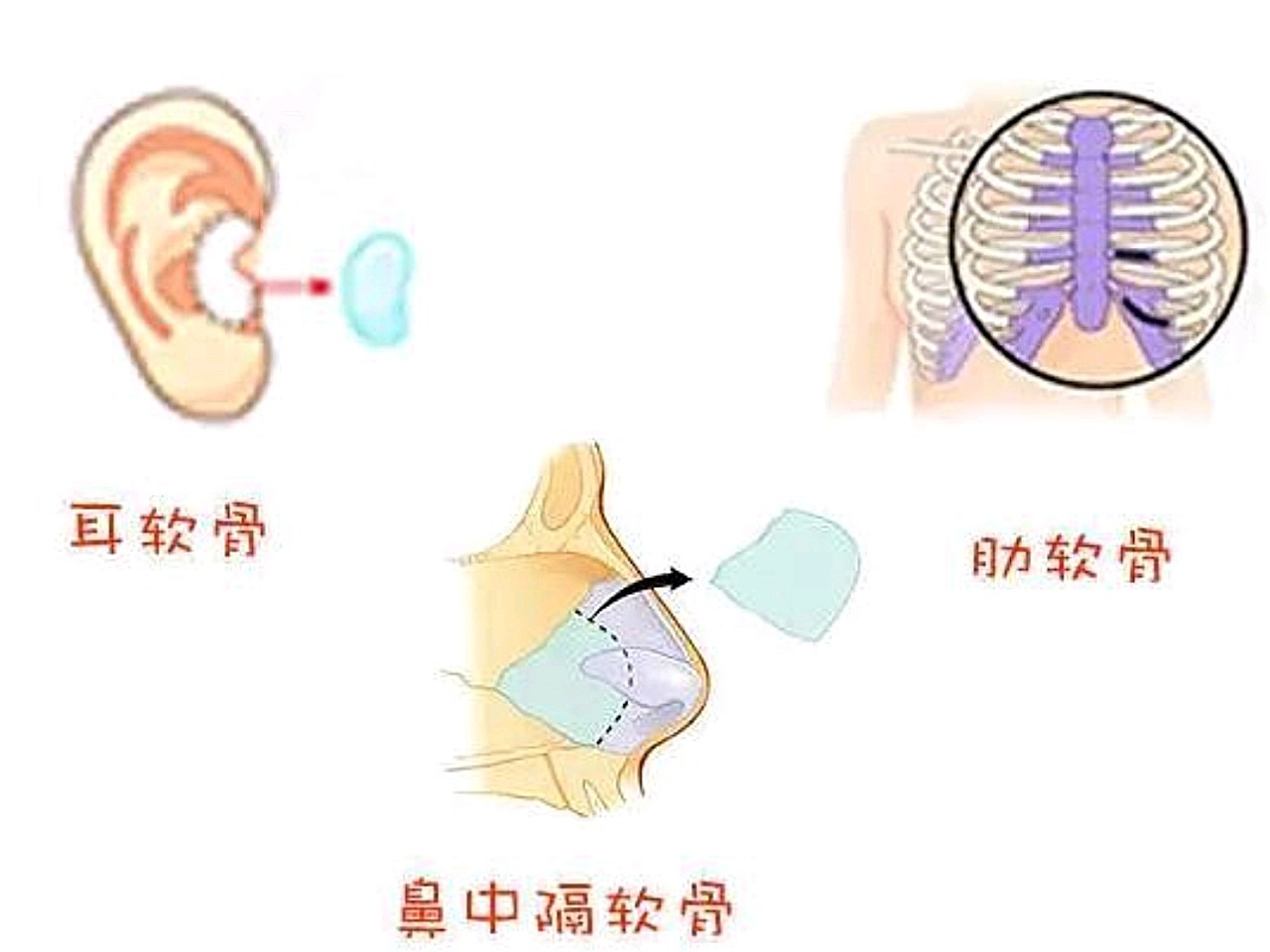 膨体 耳软骨和肋软骨 耳软骨隆鼻有什么区别呢