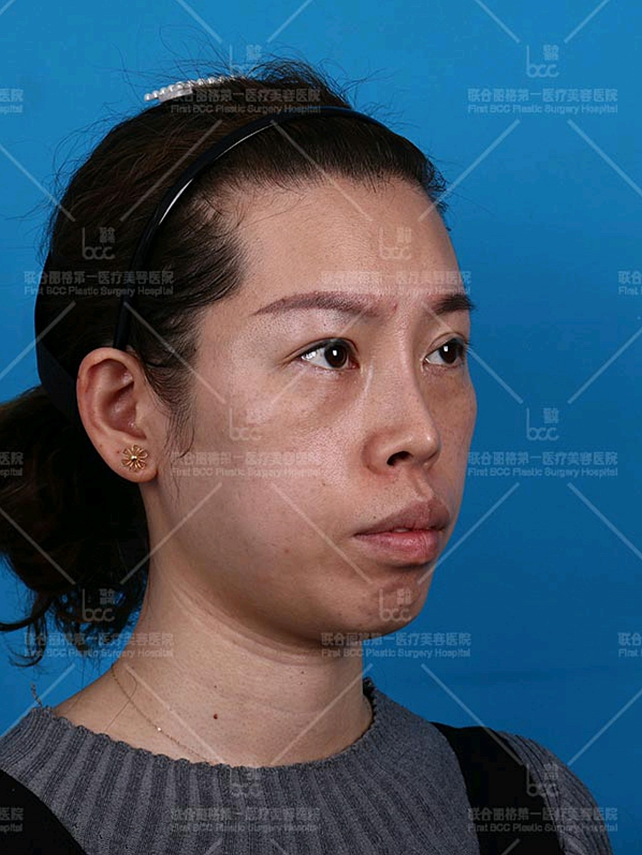 双颌前突术后第1天】我从小嘴就比较突出,气质上显_圈子-新氧美容整形