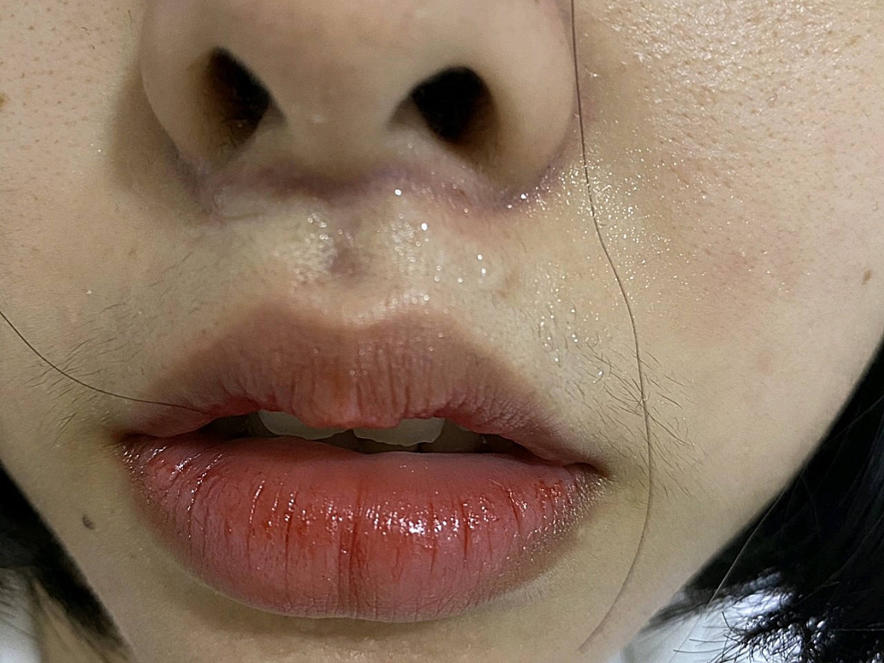 【人中缩短术】1:1:1黄金人中比例 【隐痕切口】 日式0.