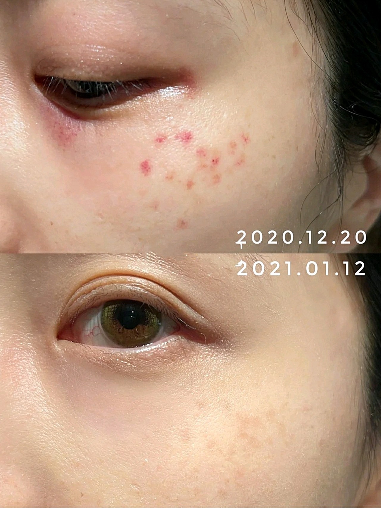 超皮秒体验后记录做了不后悔~返黑真别怕做完超皮秒快一个月了~分享