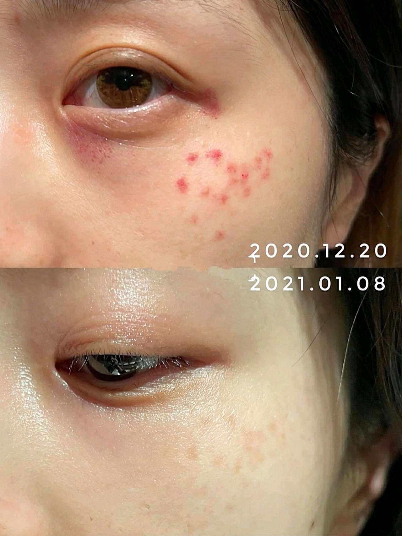 超皮秒体验后记录做了不后悔~返黑真别怕做完超皮秒快一个月了~分享