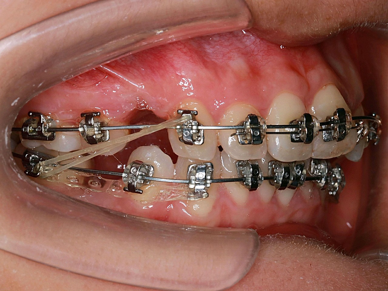 下面的5号牙都拔了上面只拔了一颗4号牙