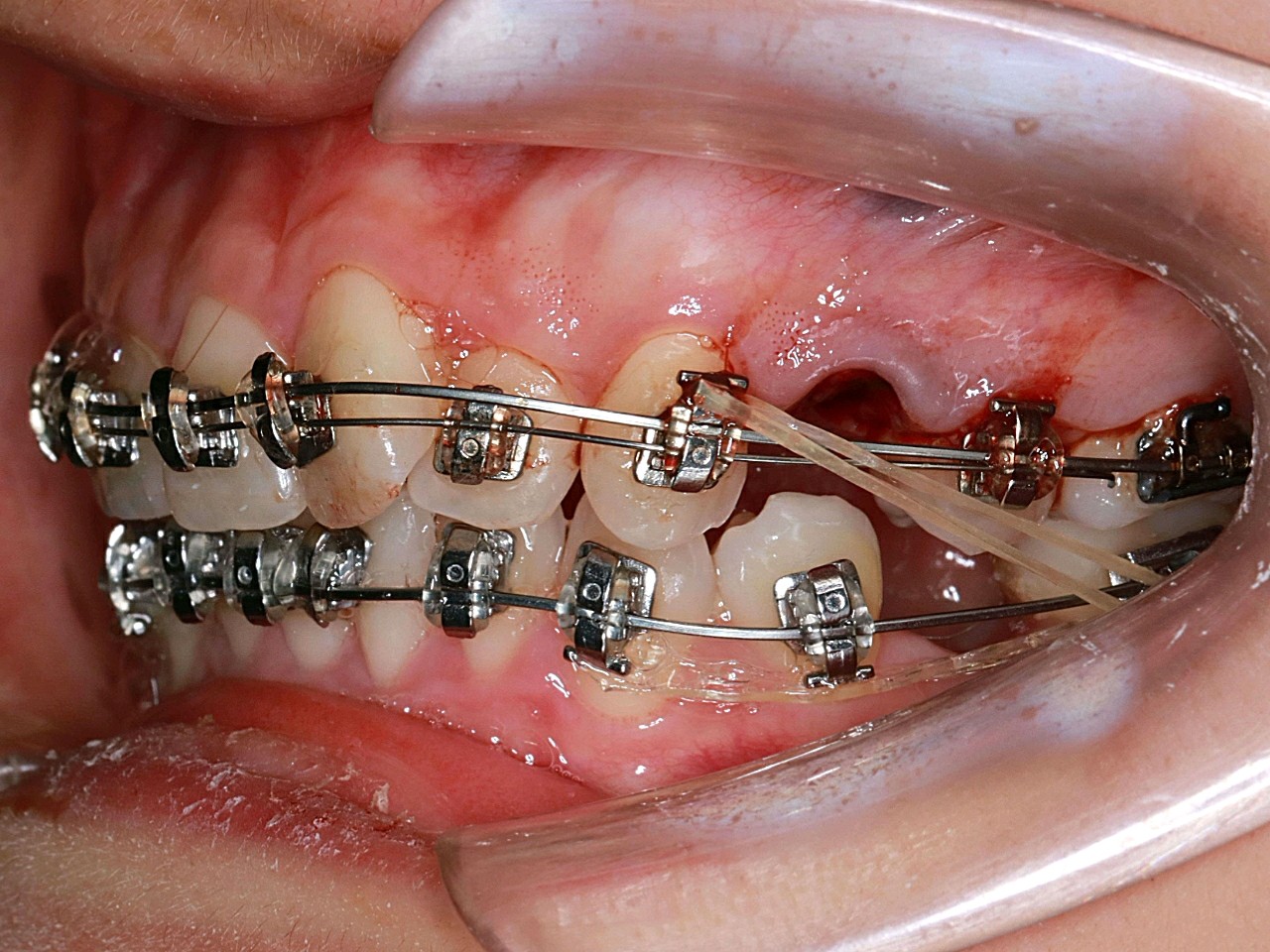 下面的5号牙都拔了上面只拔了一颗4号牙