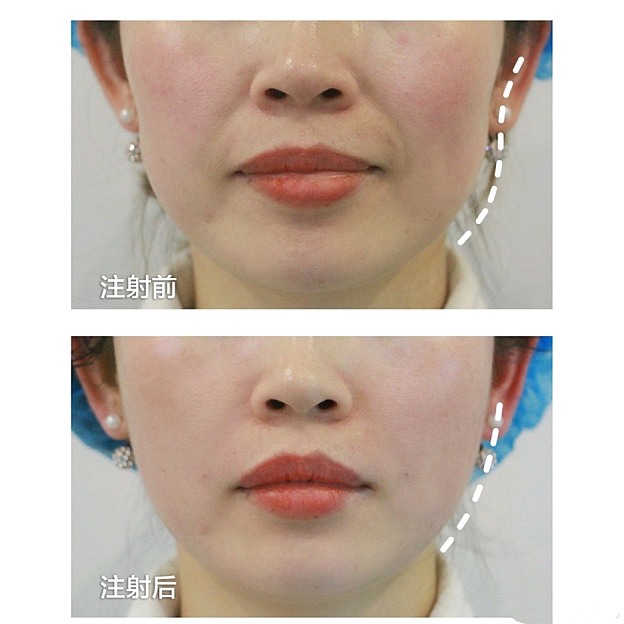 玻尿酸填充法令纹面颊