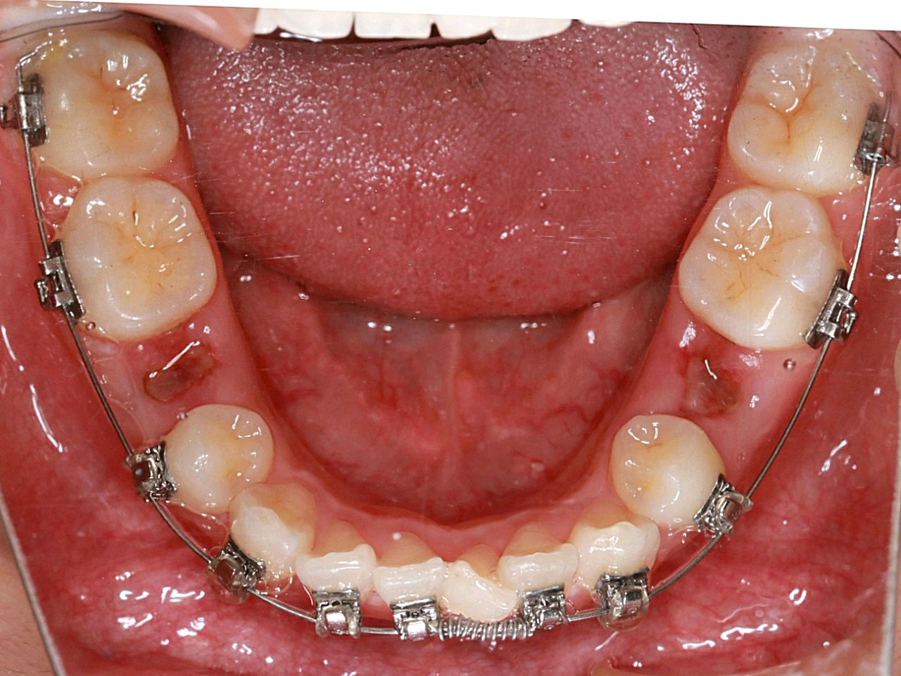 下面的5号牙都拔了上面只拔了一颗4号牙