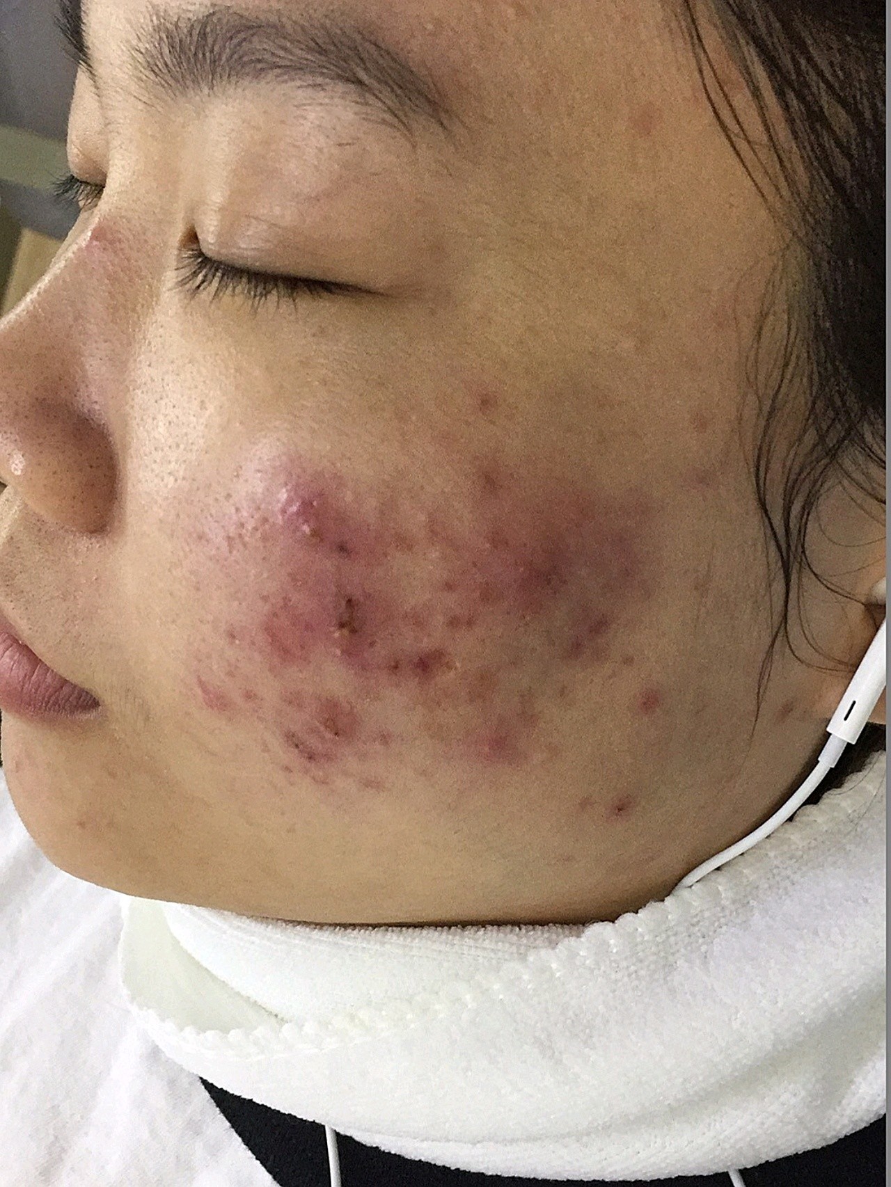 【点阵激光】 【痘坑痘印】点阵激光全脸 祛痘坑痘印 祛痘祛疤 美白