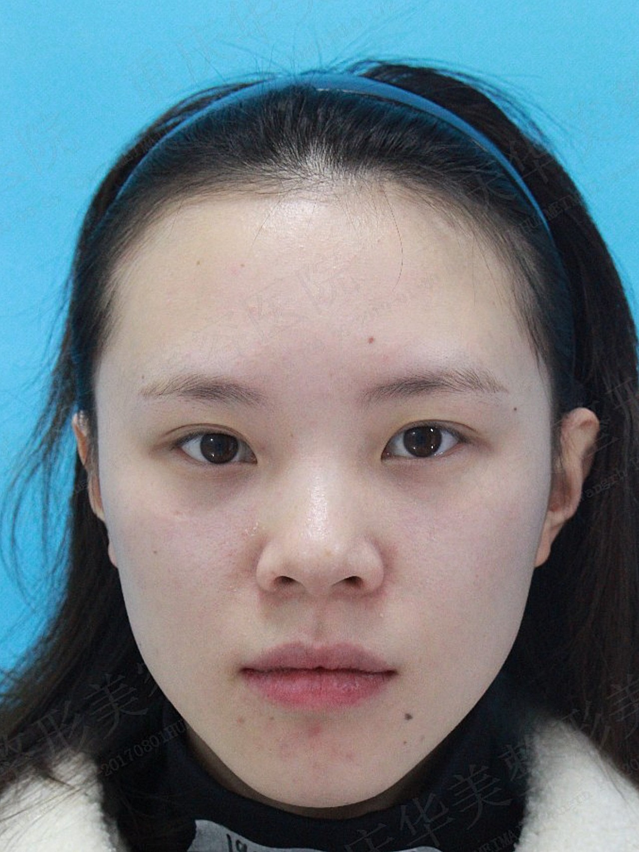 术前短鼻塌鼻鼻翼宽