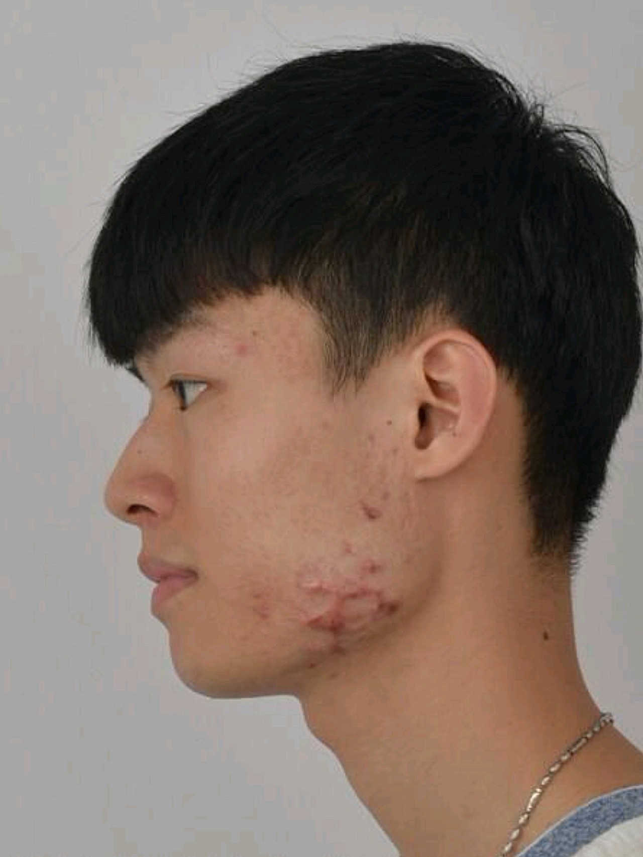 之前青春期,下颌缘长了很多痘痘,治疗的方式又不对,_圈子-新氧美容