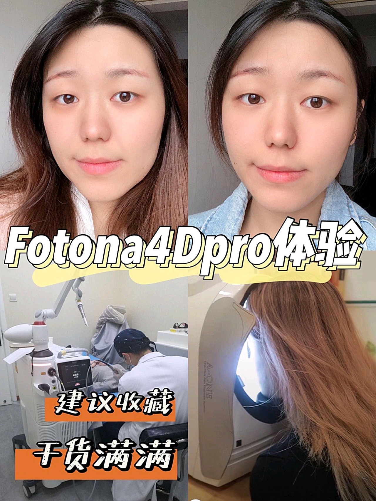 7月初做的欧洲之星fotona4dpro,因为效果太好,迫不及待的来给大家交