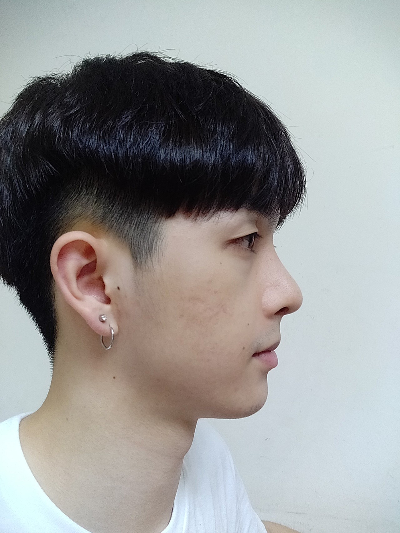 术前诊断术前短鼻,塌鼻,中面部凹陷,鼻唇角过大造成_圈子-新氧美容