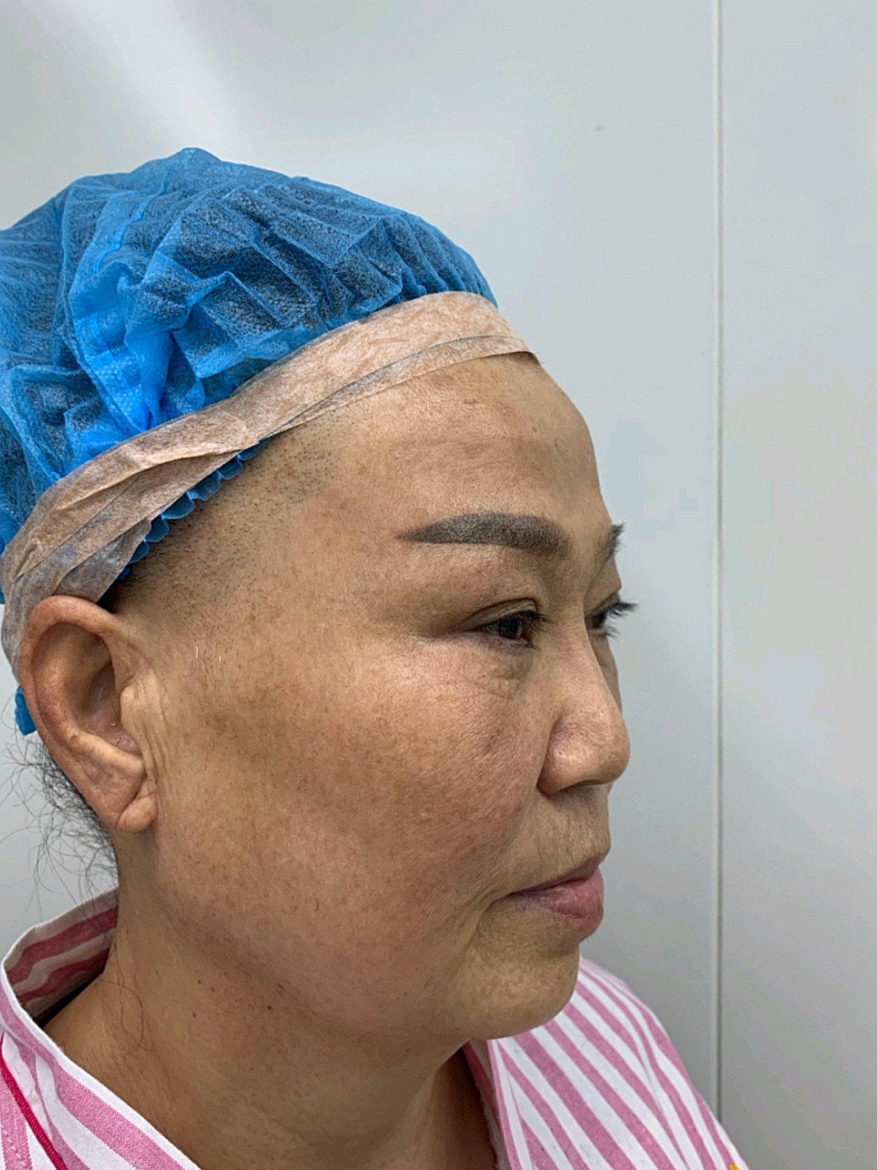 我们提倡迷你拉皮小切口,恢复后疤痕基本是不明显的,_圈子-新氧美容