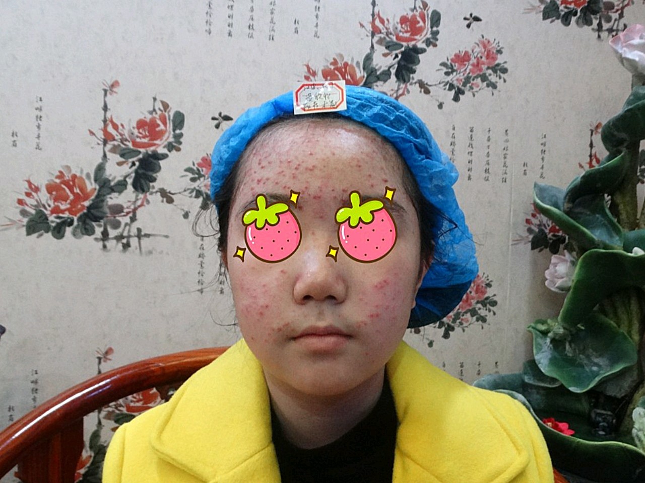 做完果酸换肤之后脸上看起来会比较红,不过不用担心,_圈子-新氧美容
