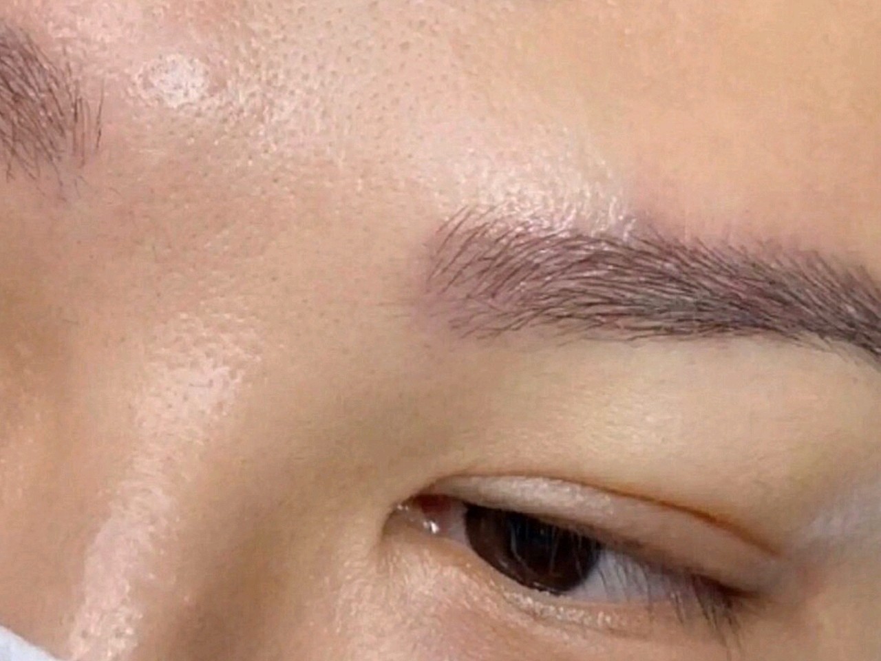 植眉前后对比,眉毛天生稀疏,眉形不好看.
