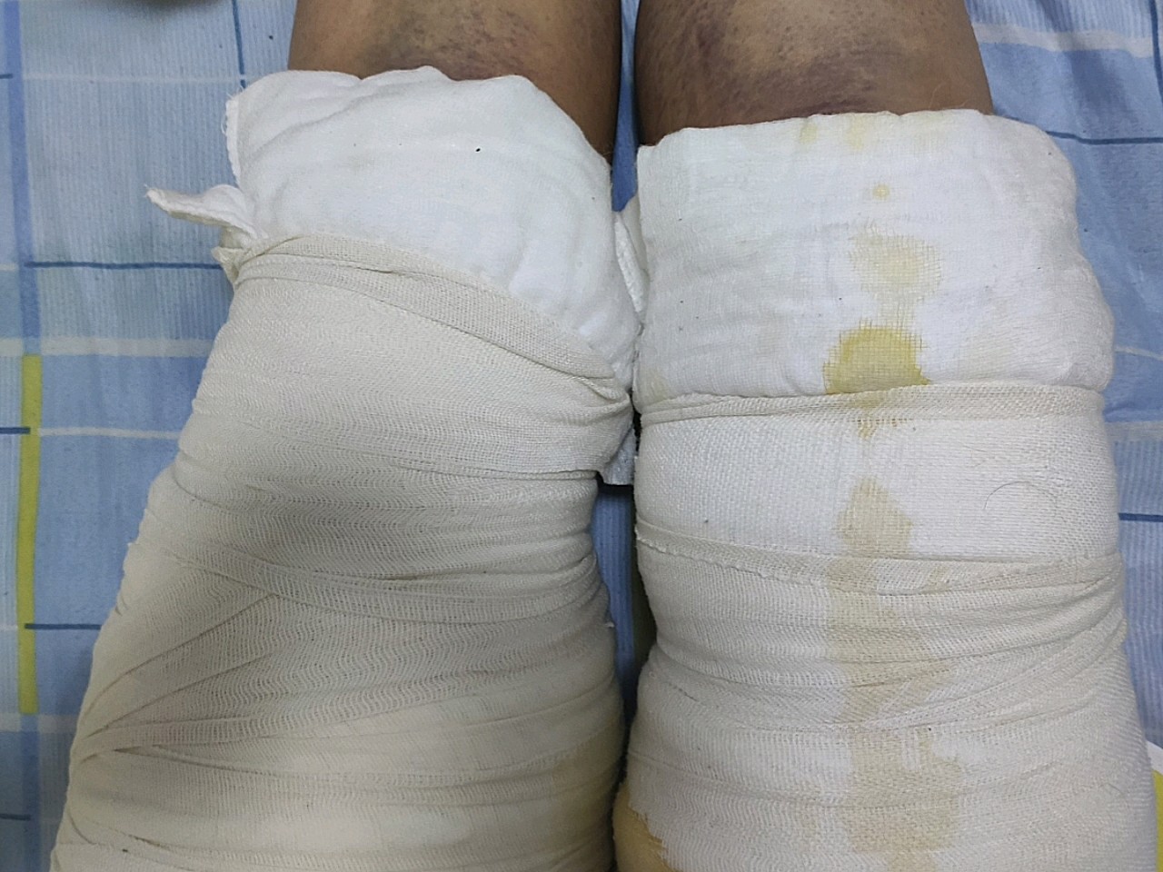 第一张图是吸完大腿第三天晚上,腿肿得厉害,小腿也都_圈子-新氧美容