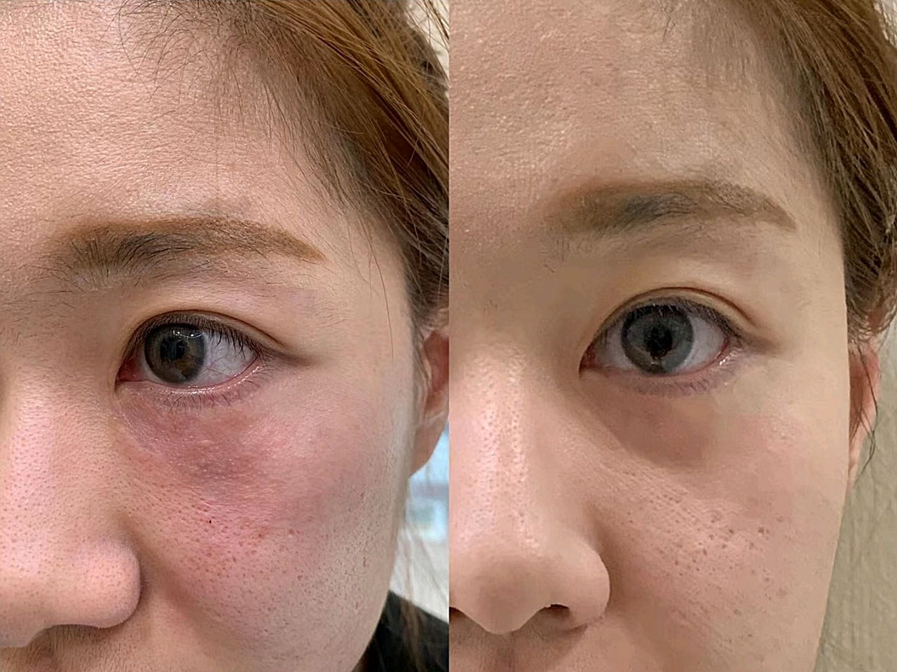 5ml ,嗨体去眼纹嗨体填泪沟嗨体眼睛手打眼周细纹 嗨体祛颈纹嗨体1.