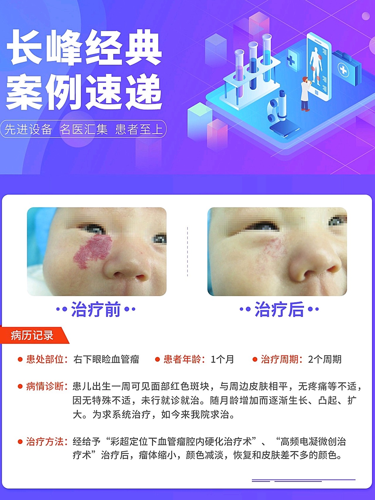 右下眼睑血管瘤治疗案例