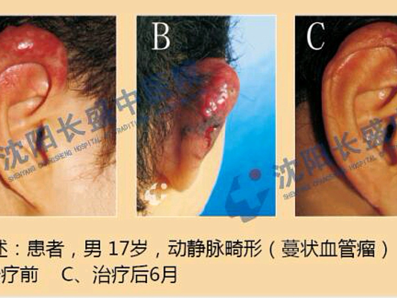 耳朵动静脉畸形治疗康复案例