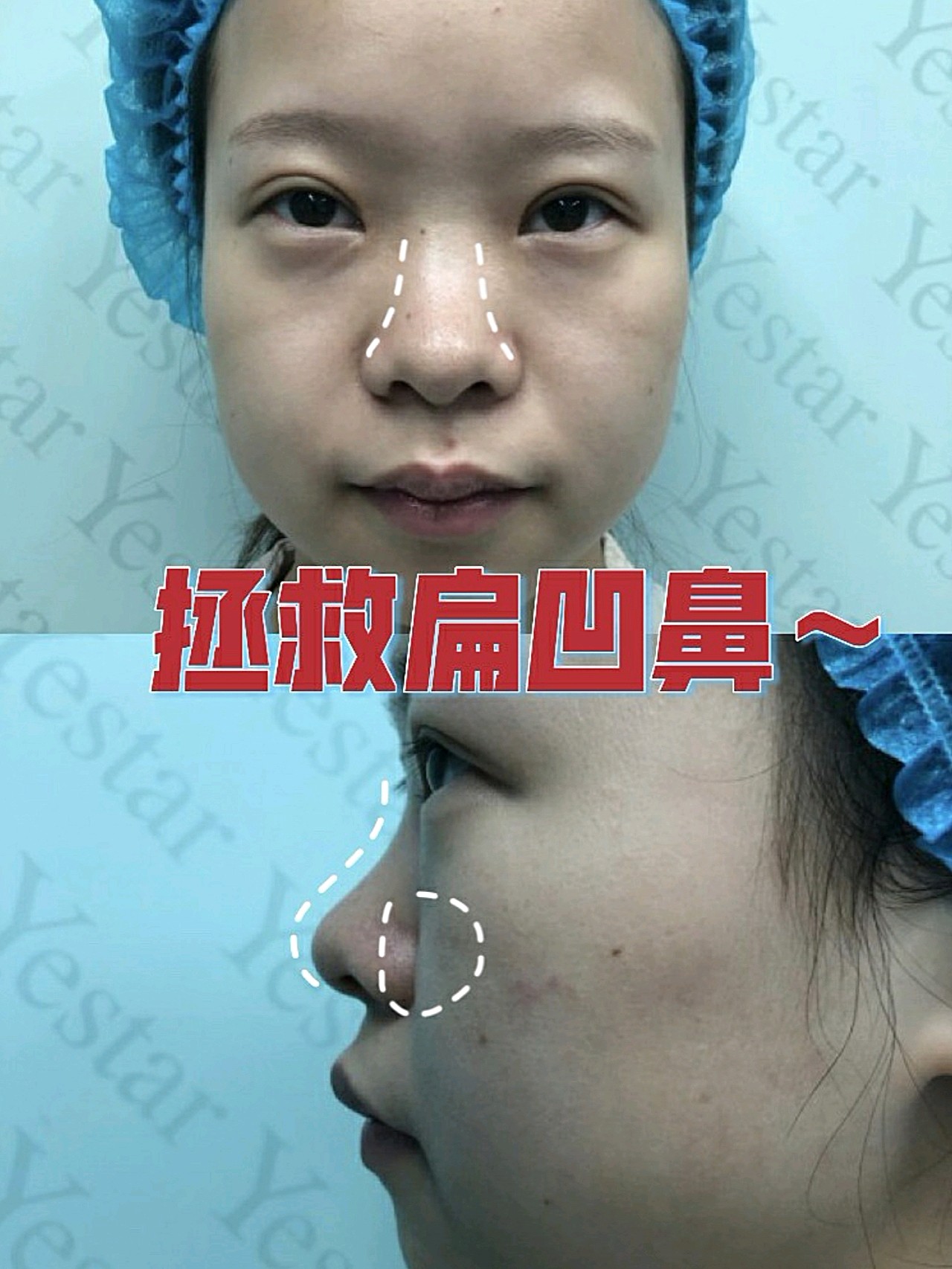 凹陷鼻图片鼻子凹陷凹鼻鼻子只垫山根效果图鼻软骨塌陷鼻子凹陷怎么办