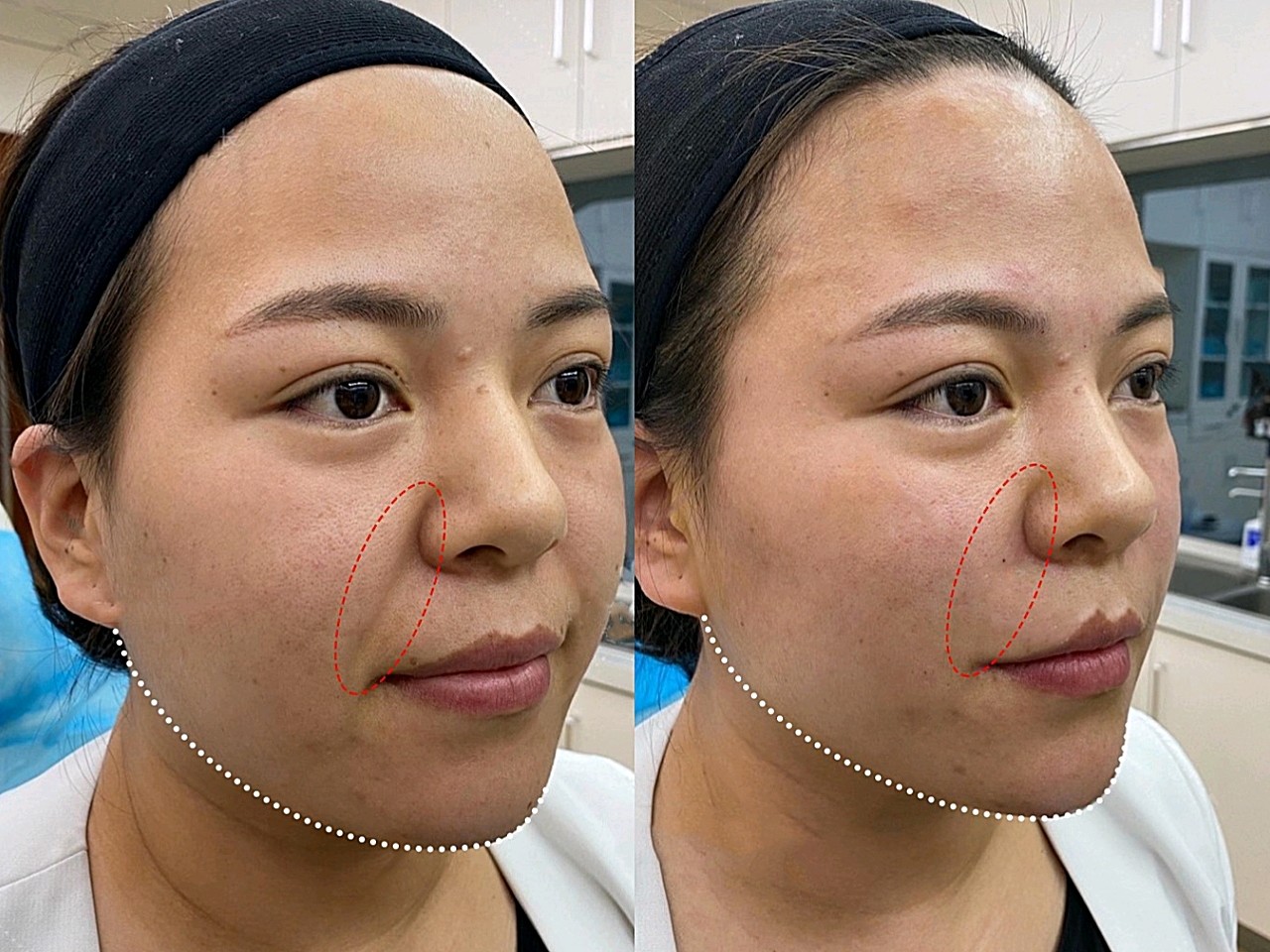 【玻尿酸真实案例分享】