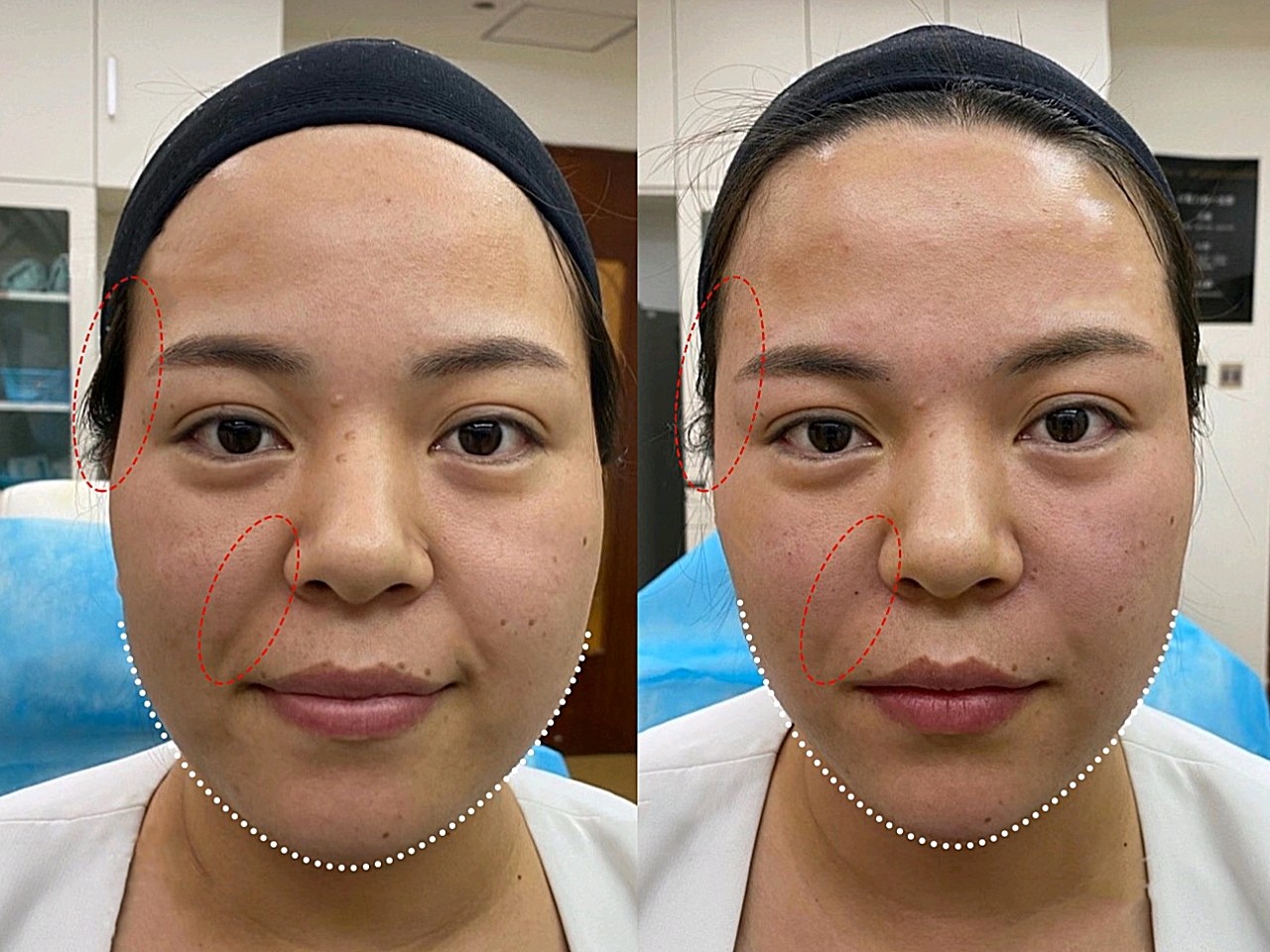 【玻尿酸真实案例分享】