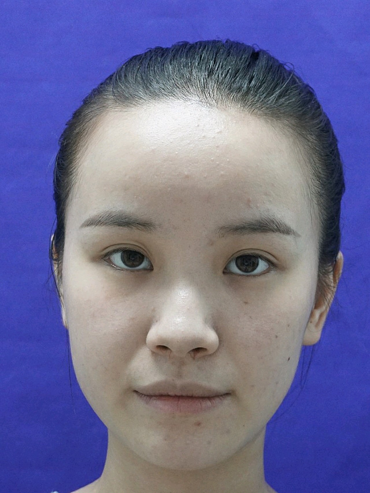 都说鼻子是颜面之王但我的鼻子不但不是颜面之王了就连基本的美感和