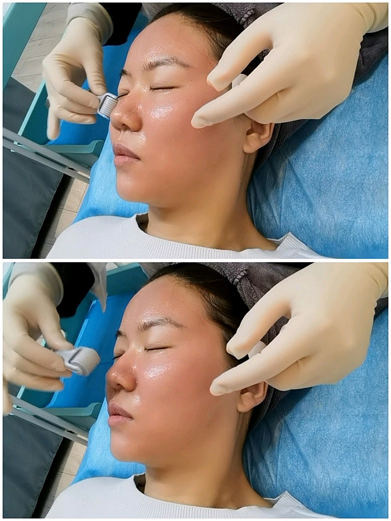 可丽金胶原微针体验一周啦!皮肤真的有改善哦