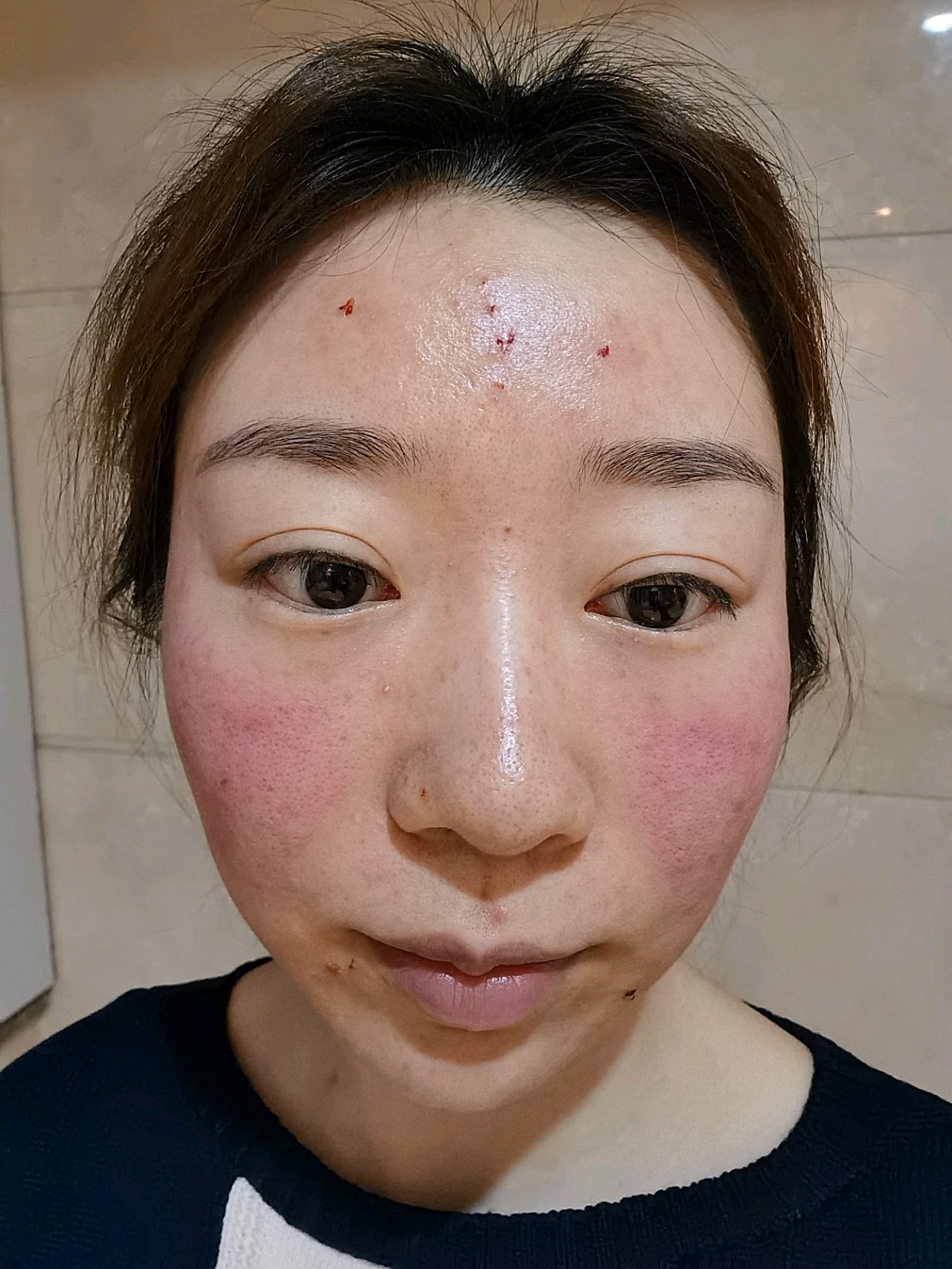 新氧试用官热拉提plus第二篇日记