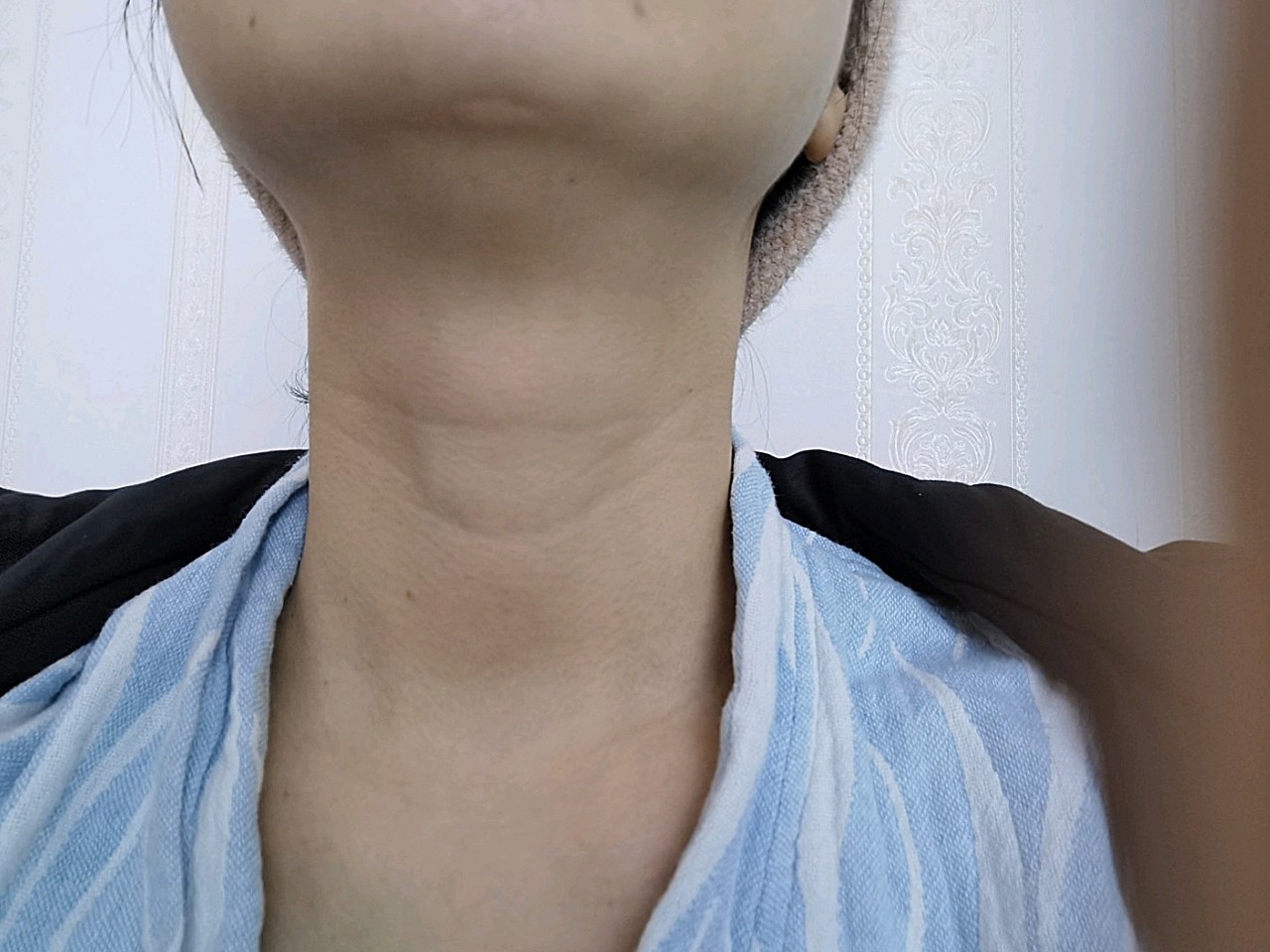 还在等瘀血消,我的颈纹比较深,用了两只,以后还要再_圈子-新氧美容