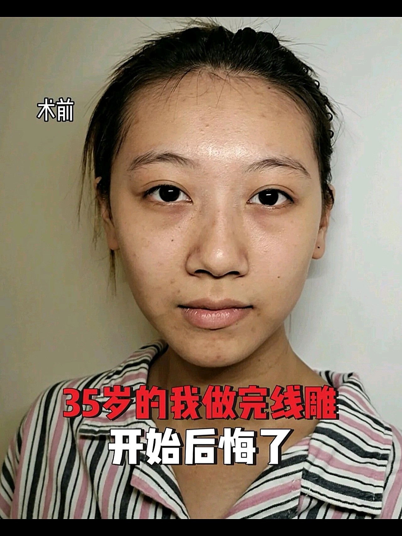 35歲的我做完線雕開始後悔了