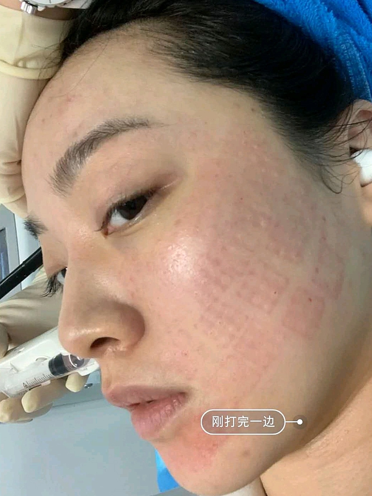 我的水光补水注射经历