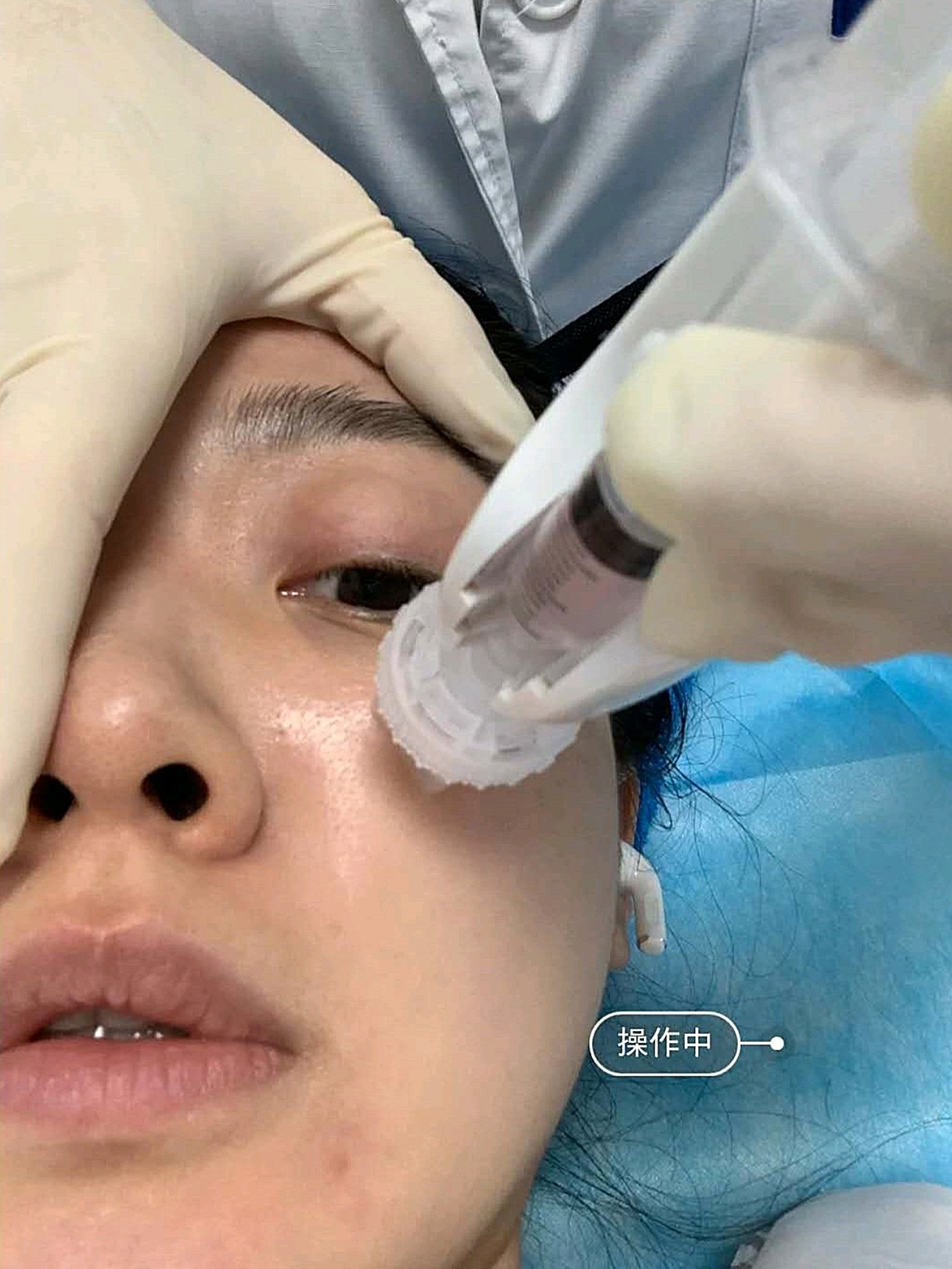 活了20多年了第一次打水光补水,_圈子-新氧美容整形