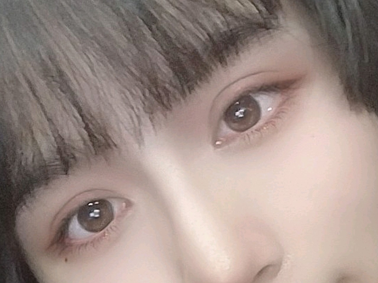 重睑内眦#双眼皮恢复